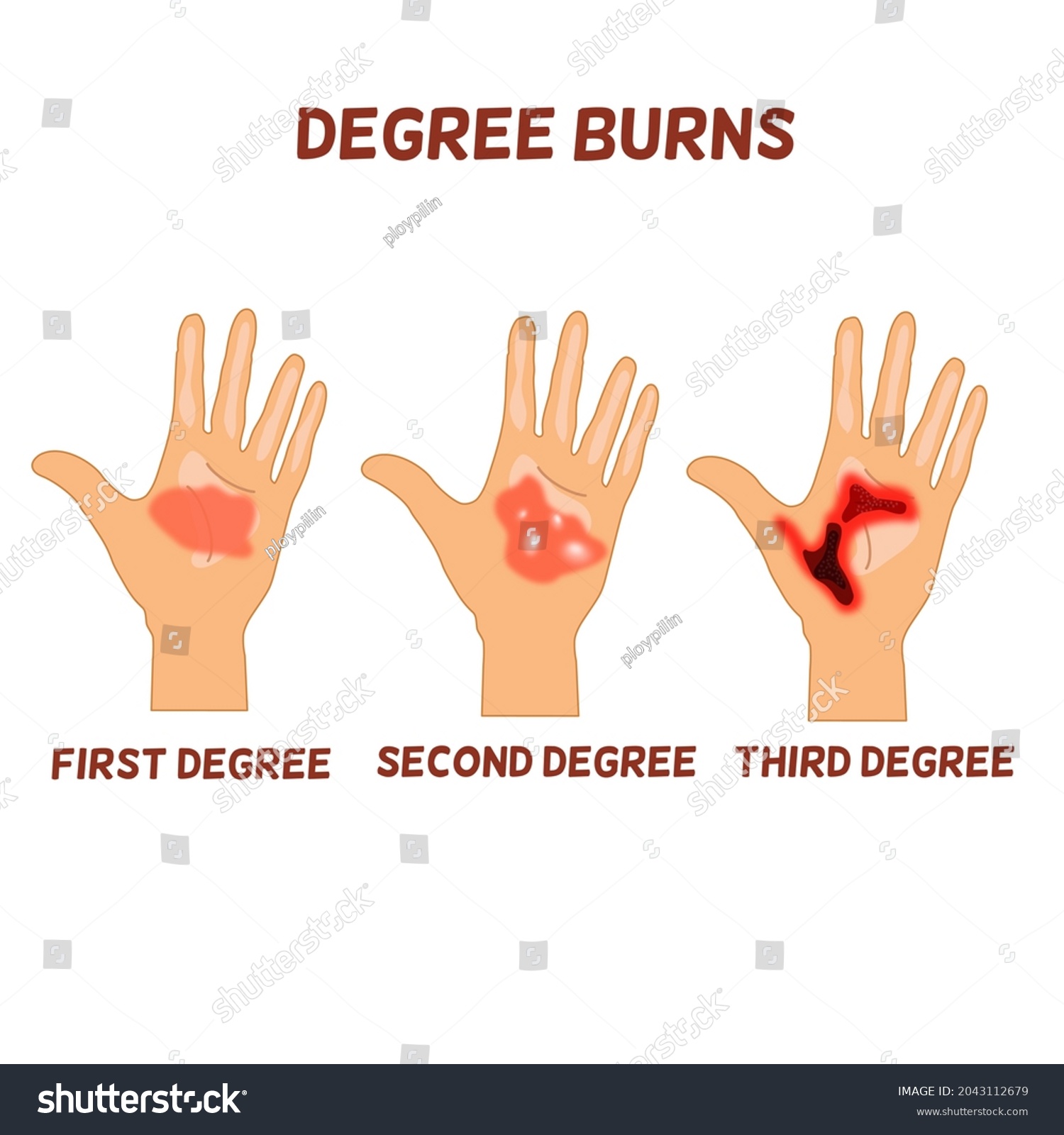 first degree second degree third degree burns