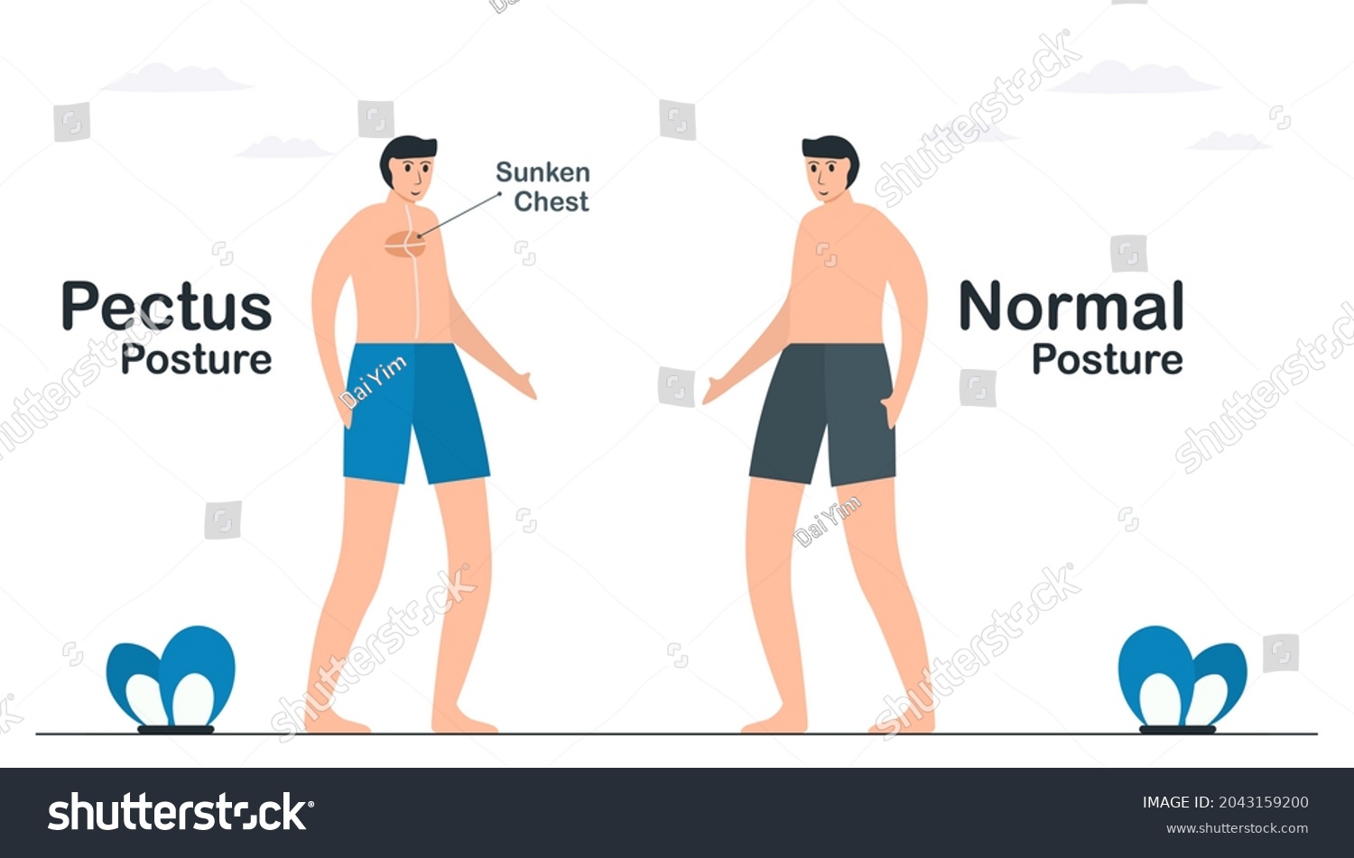 Comparison Normal Pectus Posture Pectus Excavatum Stock Vector (Royalty ...