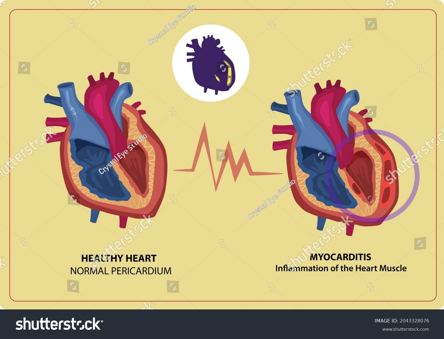 Myocarditis Inflammation Heart Muscle Comparison Healthy Stock Vector ...