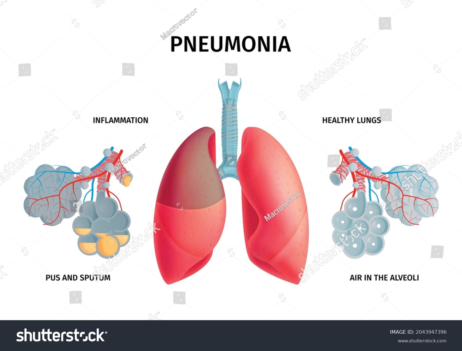 Human Lung Anatomy Infection Disease Inflammation Stock Vector (Royalty ...