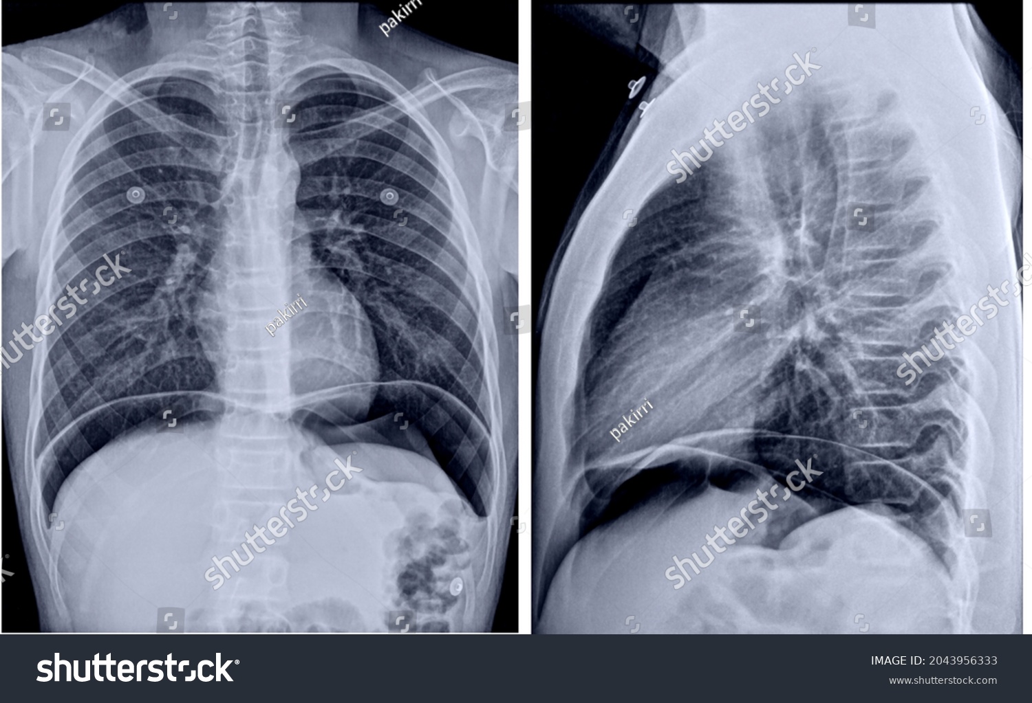 Frontal Radiography Air Peritoneum Stock Photo 2043956333 | Shutterstock