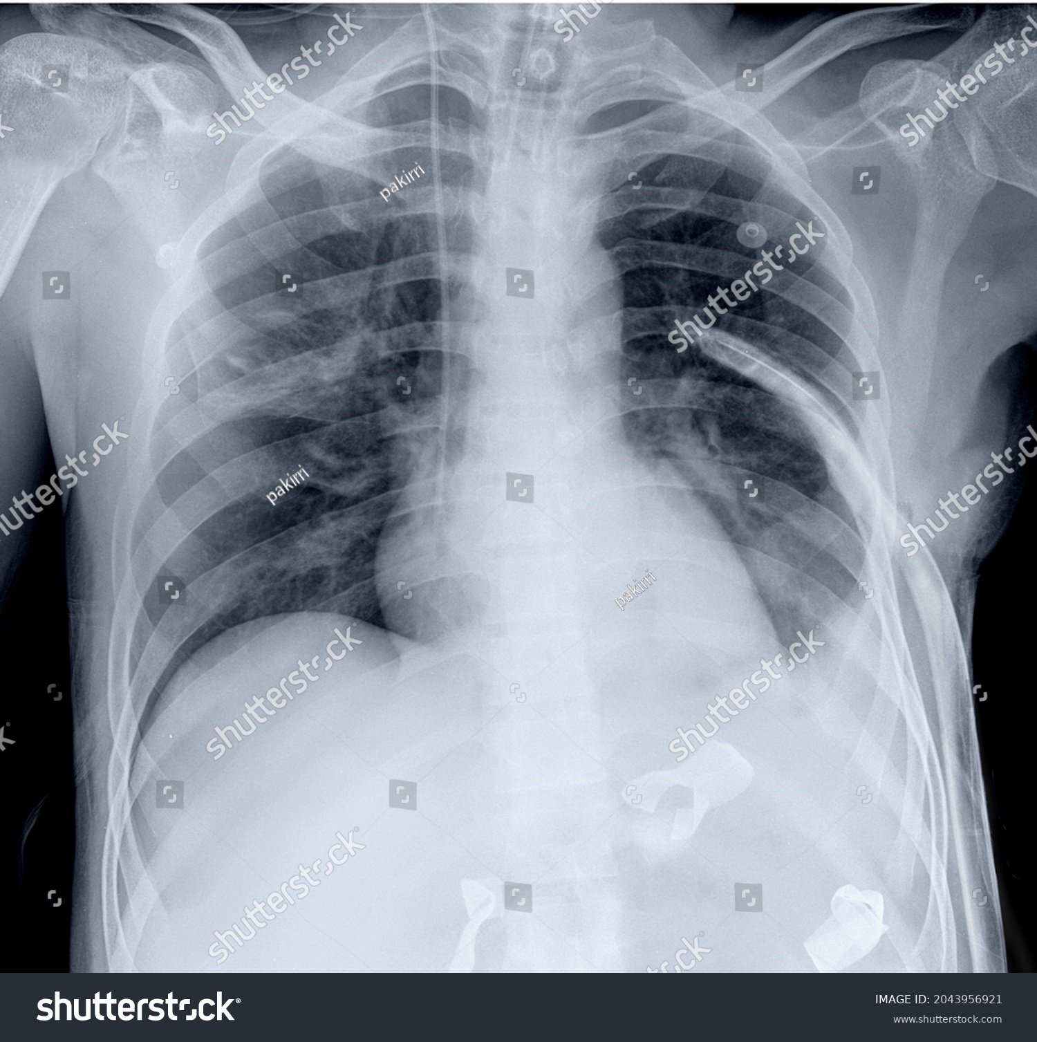 Frontal Chest Xray Complicated Pneumonia Stock Photo 2043956921 ...