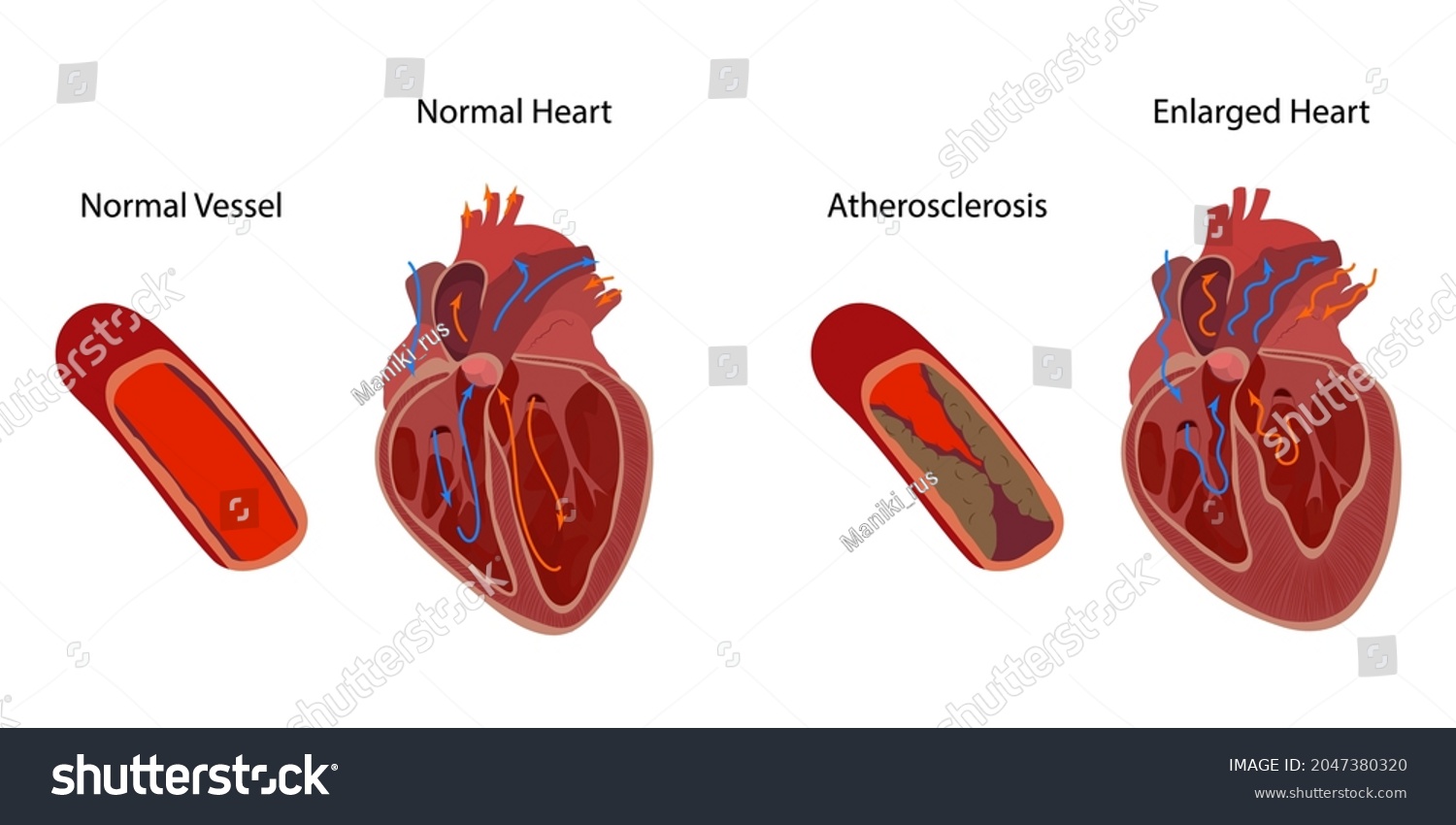 Normal Enlarged Heart Cardiomegaly Atherosclerosis Direction Stock ...