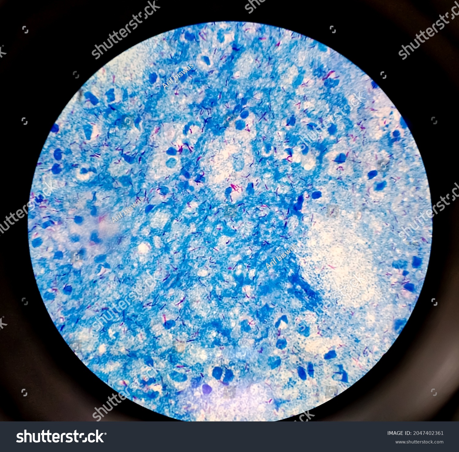 Sputum Smear Afb Stain Microscopic 100x Stock Photo 2047402361 ...