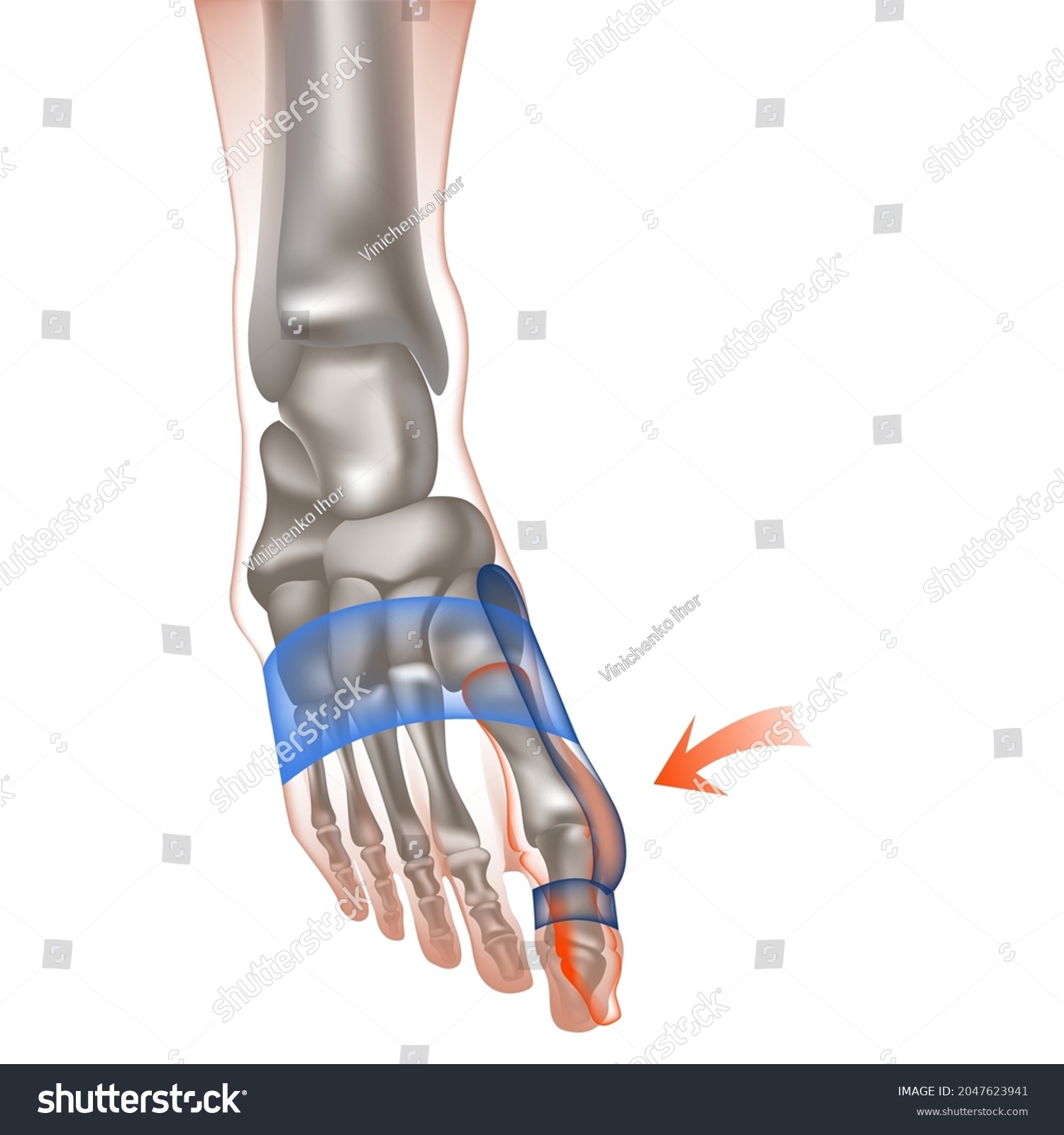 Hallux Valgus Human Foot Protruding Thumb Stock Vector (Royalty Free ...