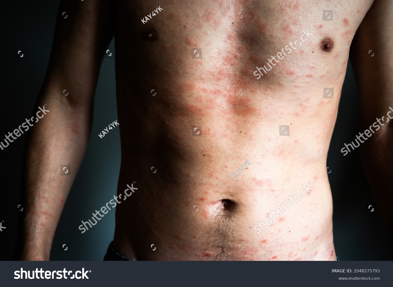 Skin Imperfection Naked Man Skin Allergy Stock Photo Shutterstock