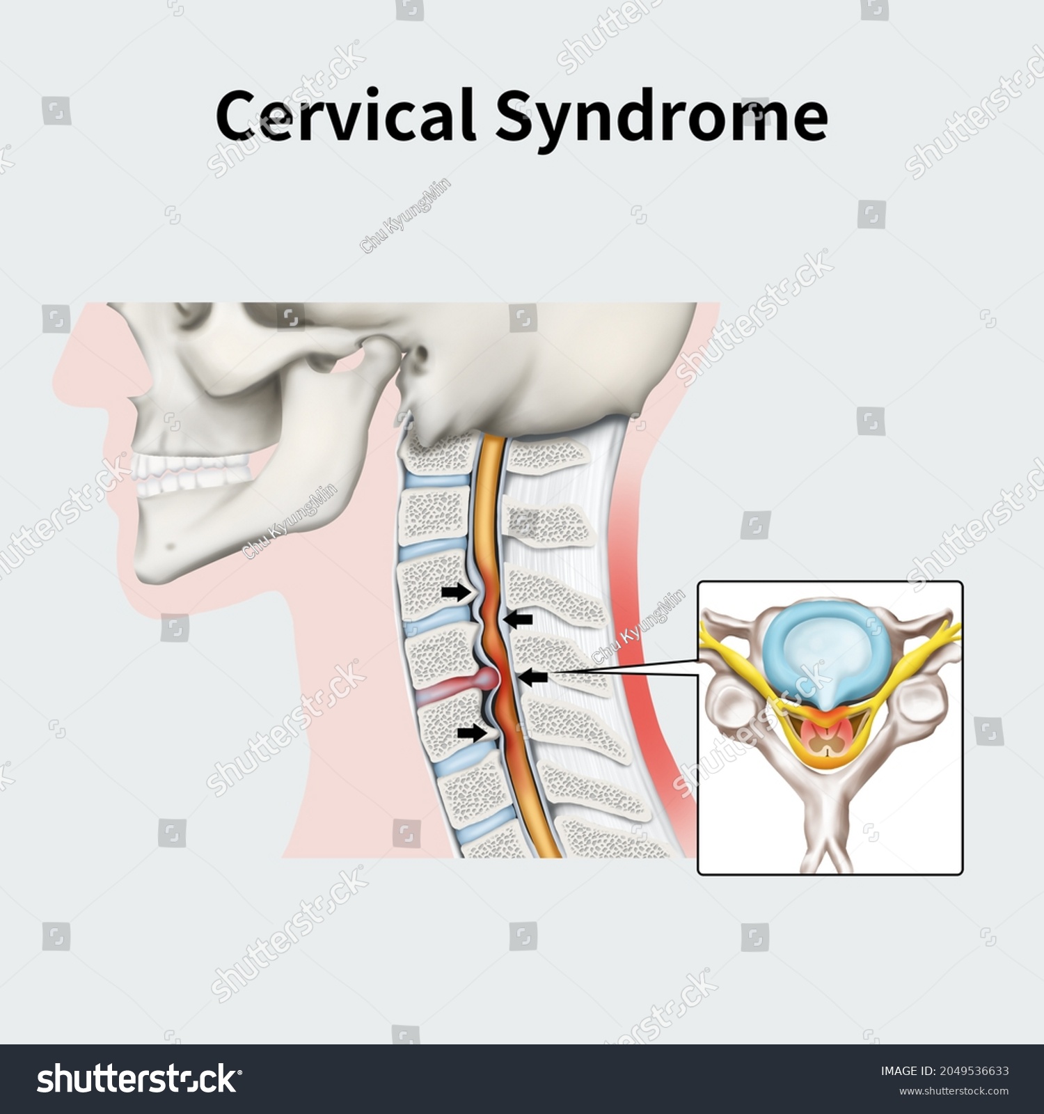 Medical Illustration Explain Cervical Syndrome Stock Illustration ...