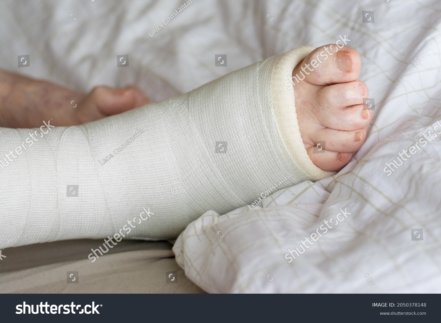 Ankle Cast On Elderly Person Fracture Stock Photo 2050378148 | Shutterstock