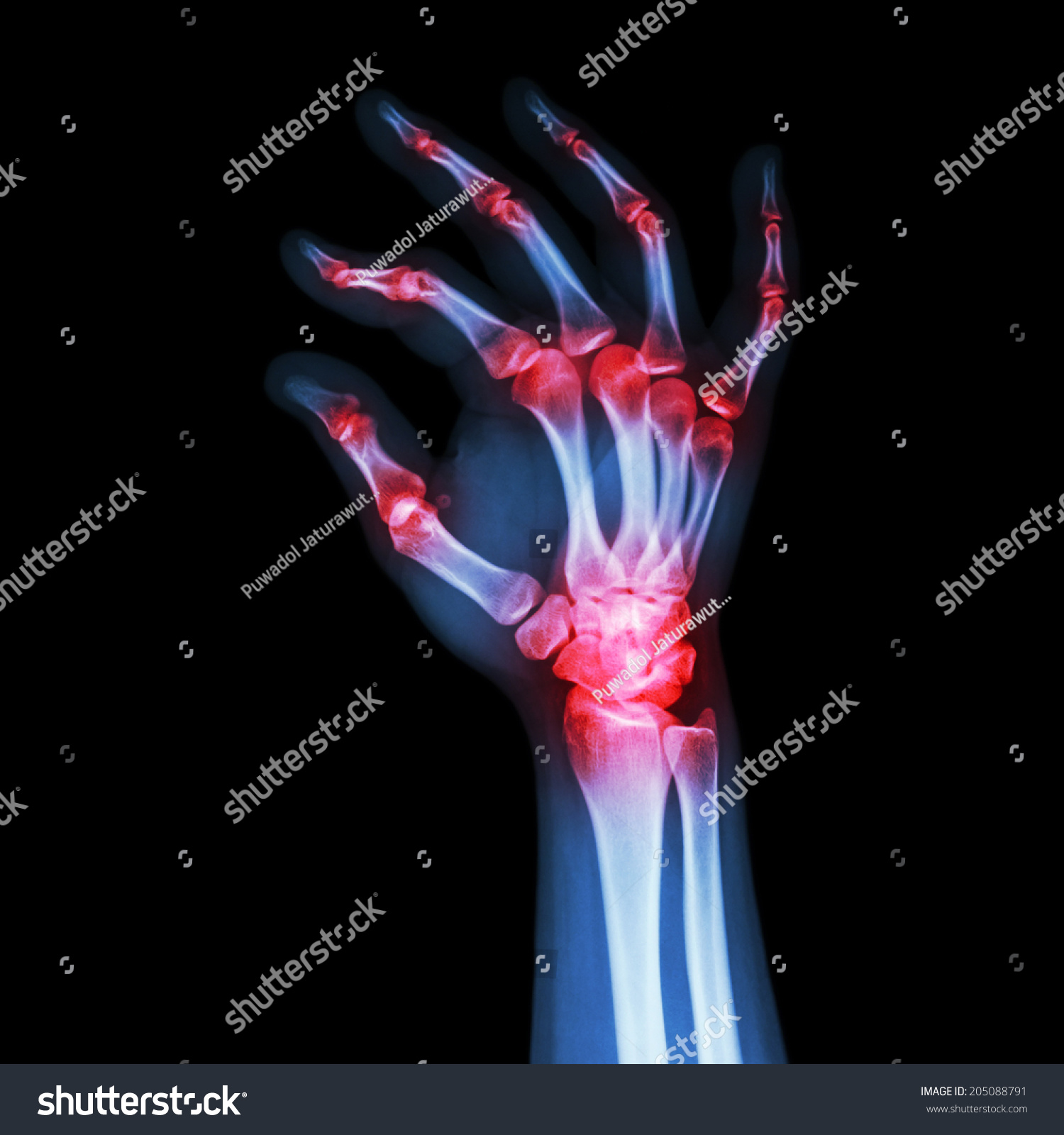 Rheumatoid Arthritis Gouty Arthritis Xray Adults Stock Photo 205088791 