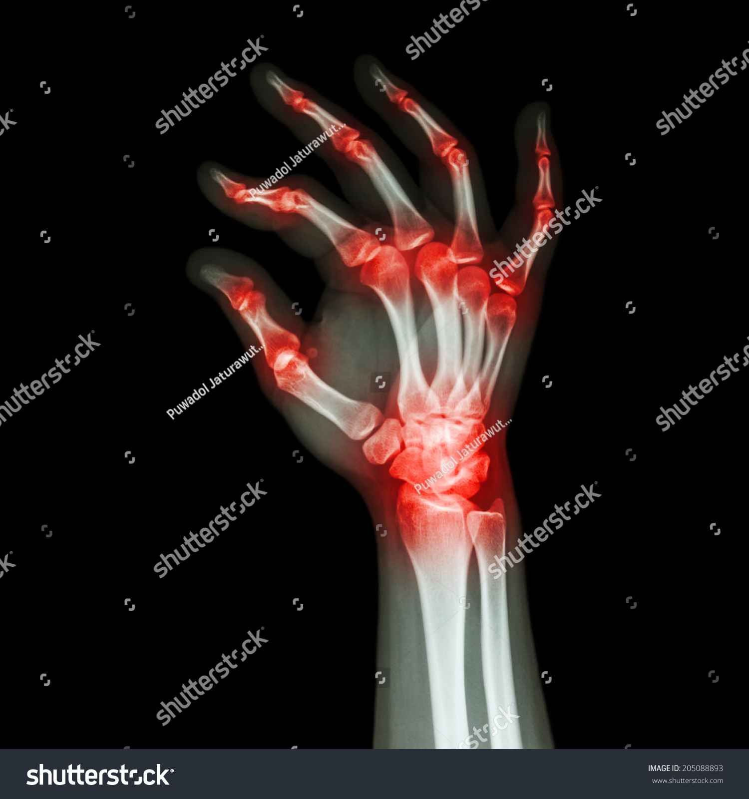 Rheumatoid Arthritis Gouty Arthritis Xray Adults Stock Photo 205088893 ...