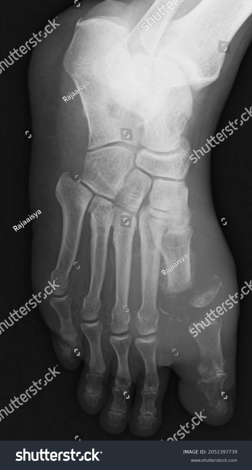 Xray Image Osteomyelitis Pedis Stock Photo 2052397739 | Shutterstock