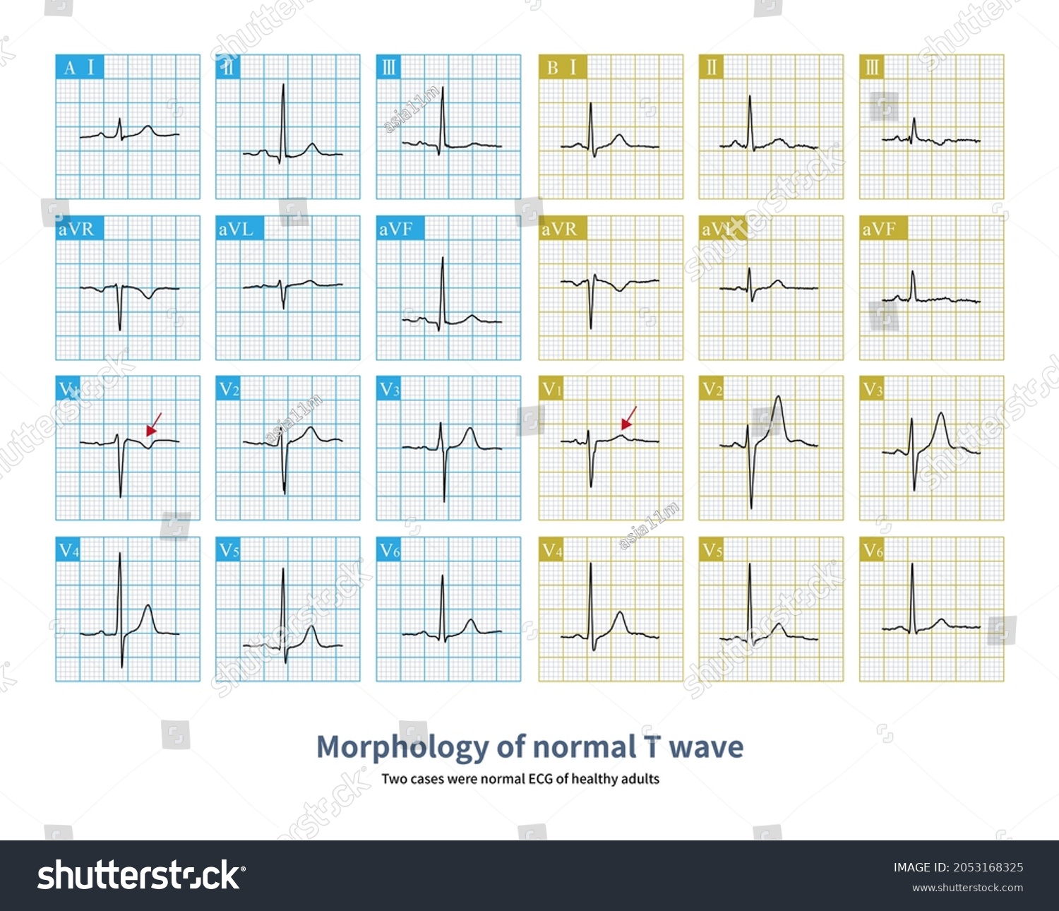 Under Normal Conditions T Wave V1 Stock Illustration 2053168325 ...