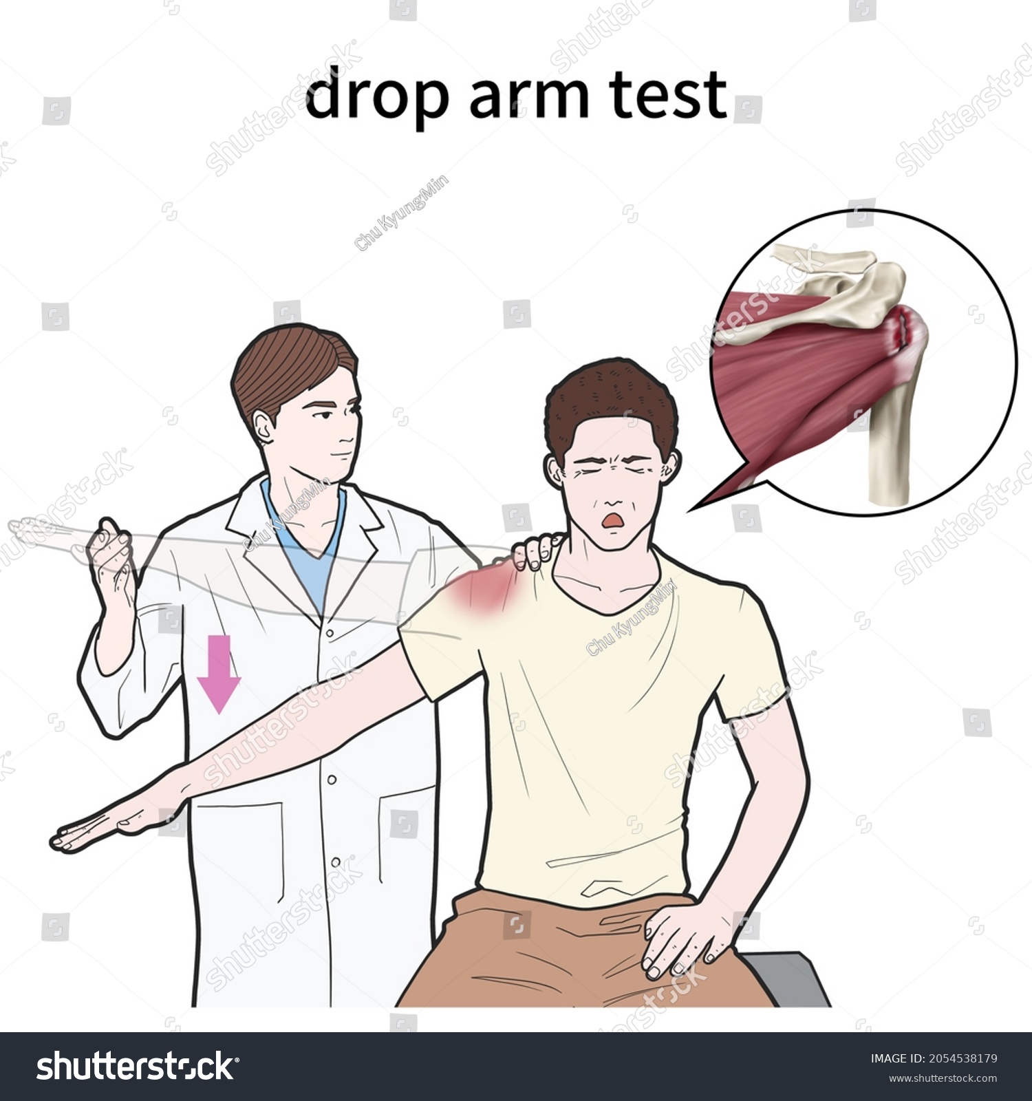 3d Medical Illustration Explain Drop Arm Stock Illustration 2054538179 ...