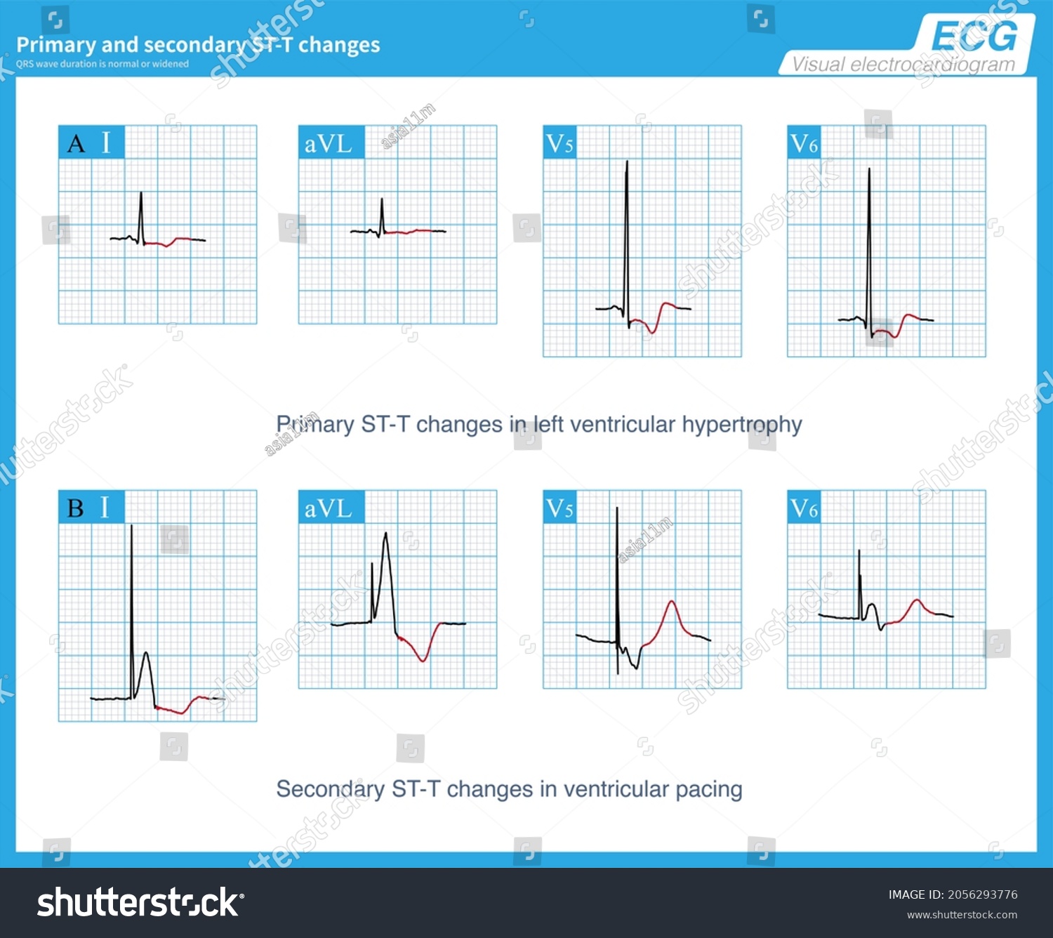 Stt Changes Normal Ventricular Depolarization Called Stock Illustration ...