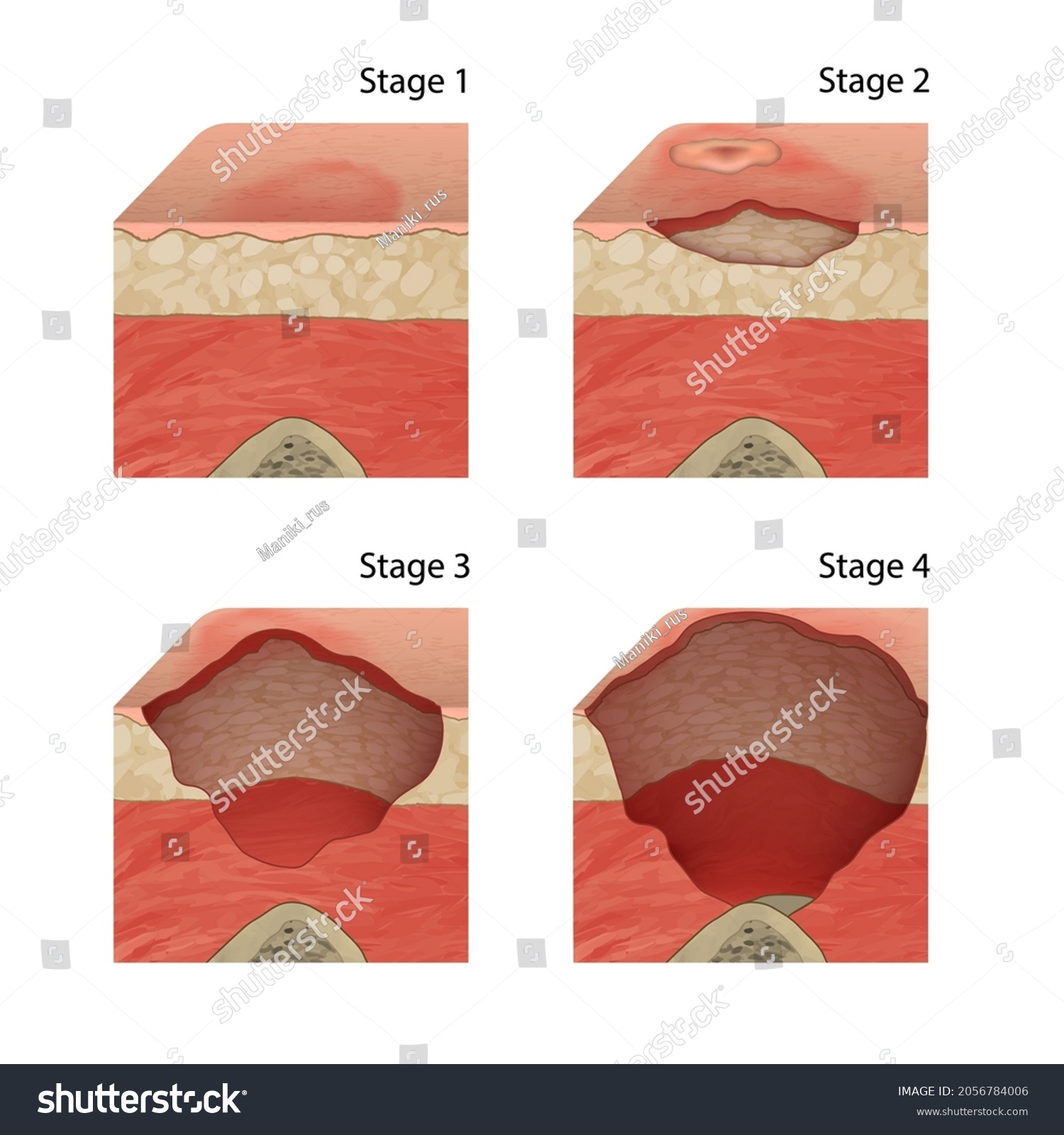 Pressure Ulcers Injuries Skin Underlying Tissue Stock Vector (Royalty ...