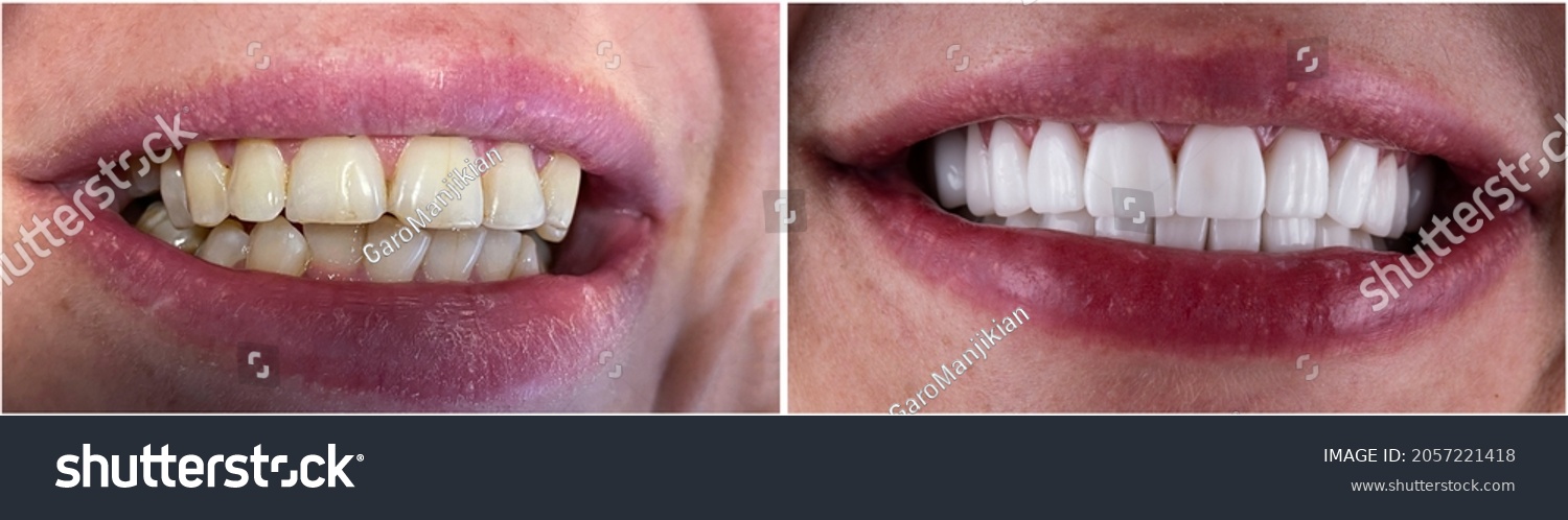 Press Ceramic Crowns Veneers B1 Color Stock Photo 2057221418 | Shutterstock