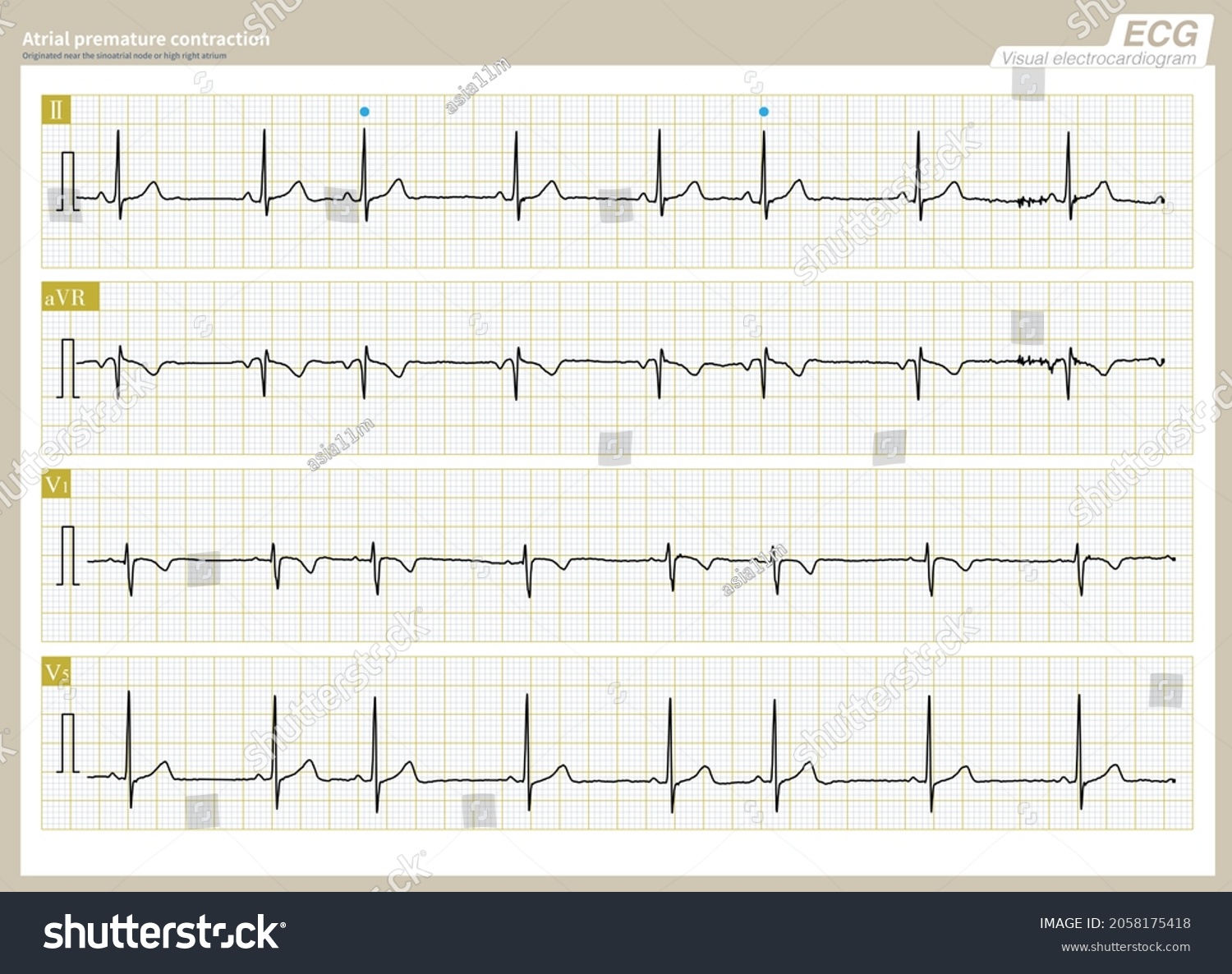 Originating Atrial Premature Contraction Near Sinus Stock Illustration ...