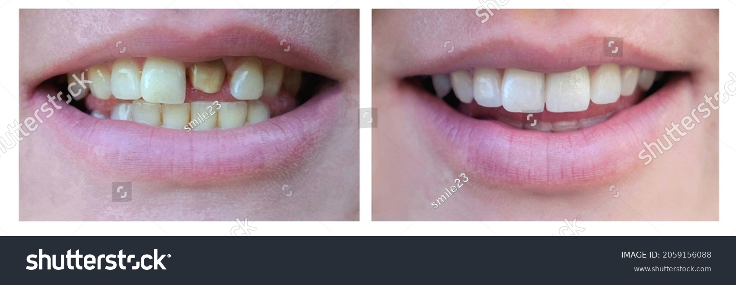 Smiling Woman Bad Tooth Before After Stock Photo 2059156088 | Shutterstock