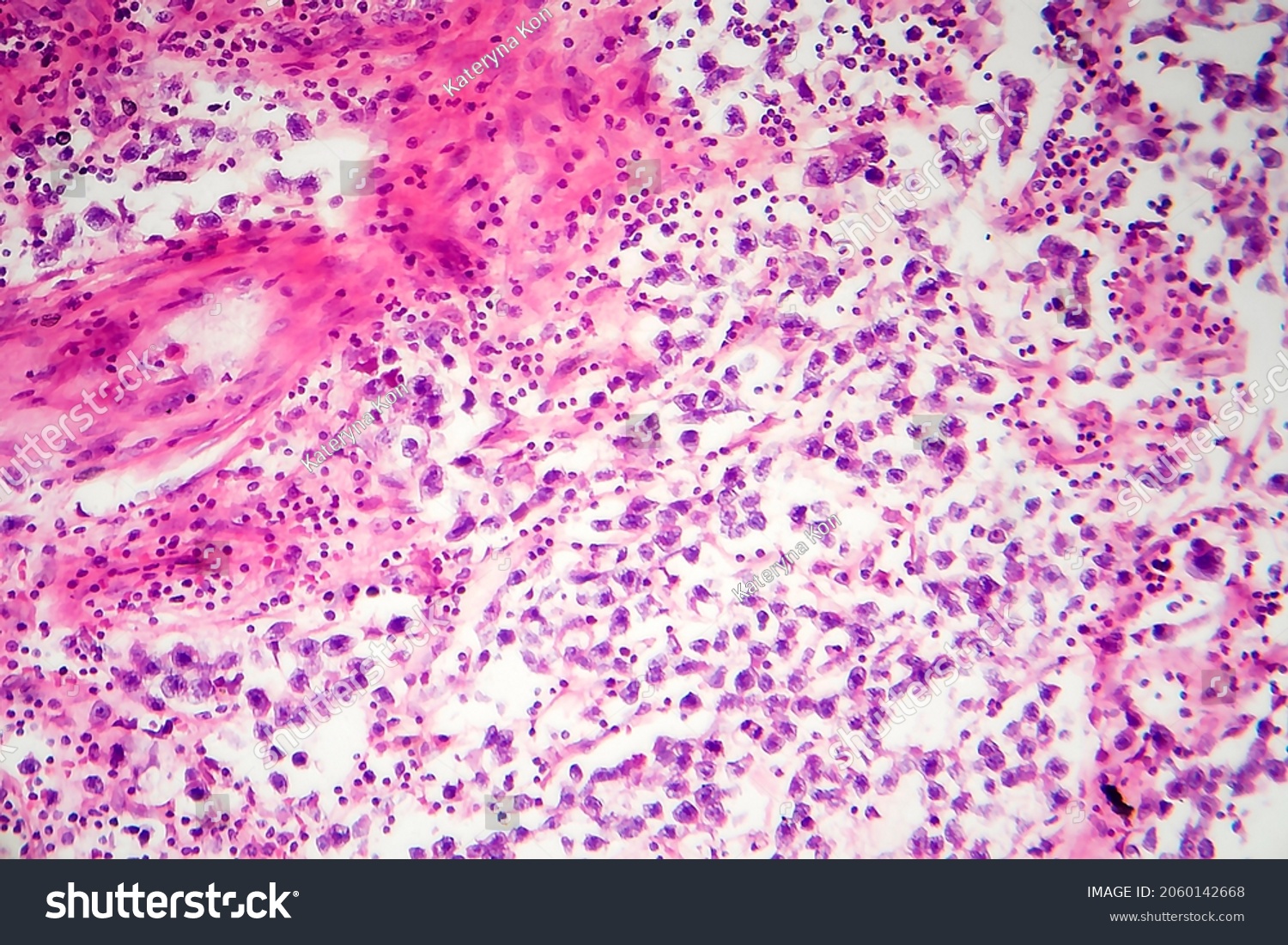 Testicular Seminoma Light Micrograph Photo Under Stock Photo