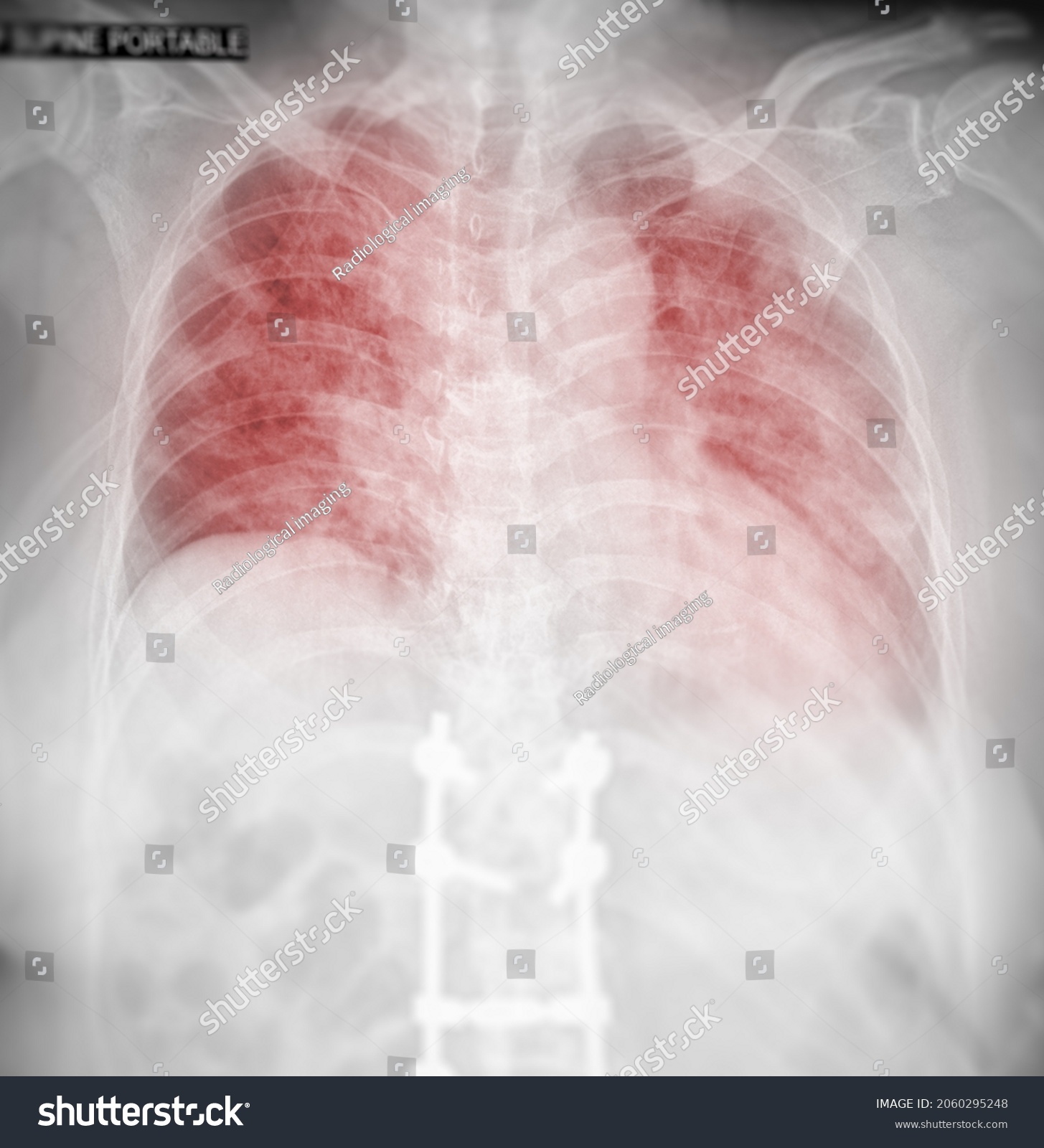 Chest Xray Human Chest Lung Showing Stock Illustration 2060295248 ...