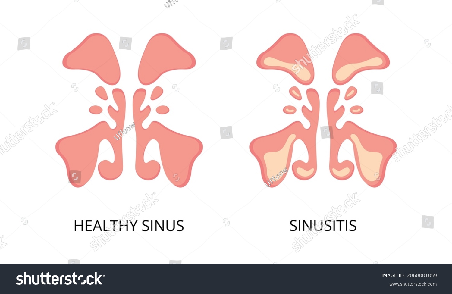 Healthy Sinus Sinusitis Flat Image Infection Stock Vector (Royalty Free ...