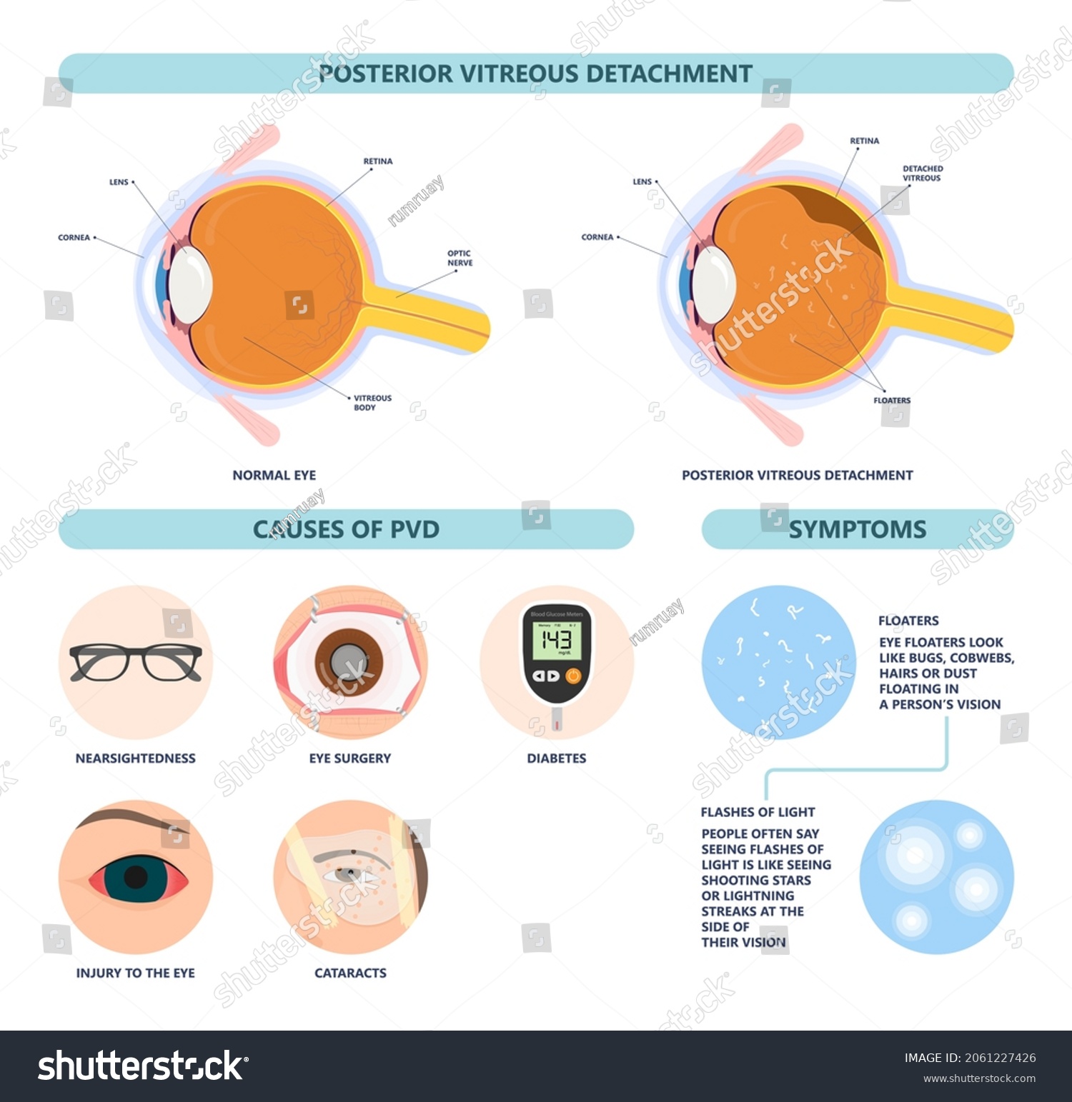 Eye Floaters Fluid Vision Retina Myopia Stock Vector (Royalty Free ...