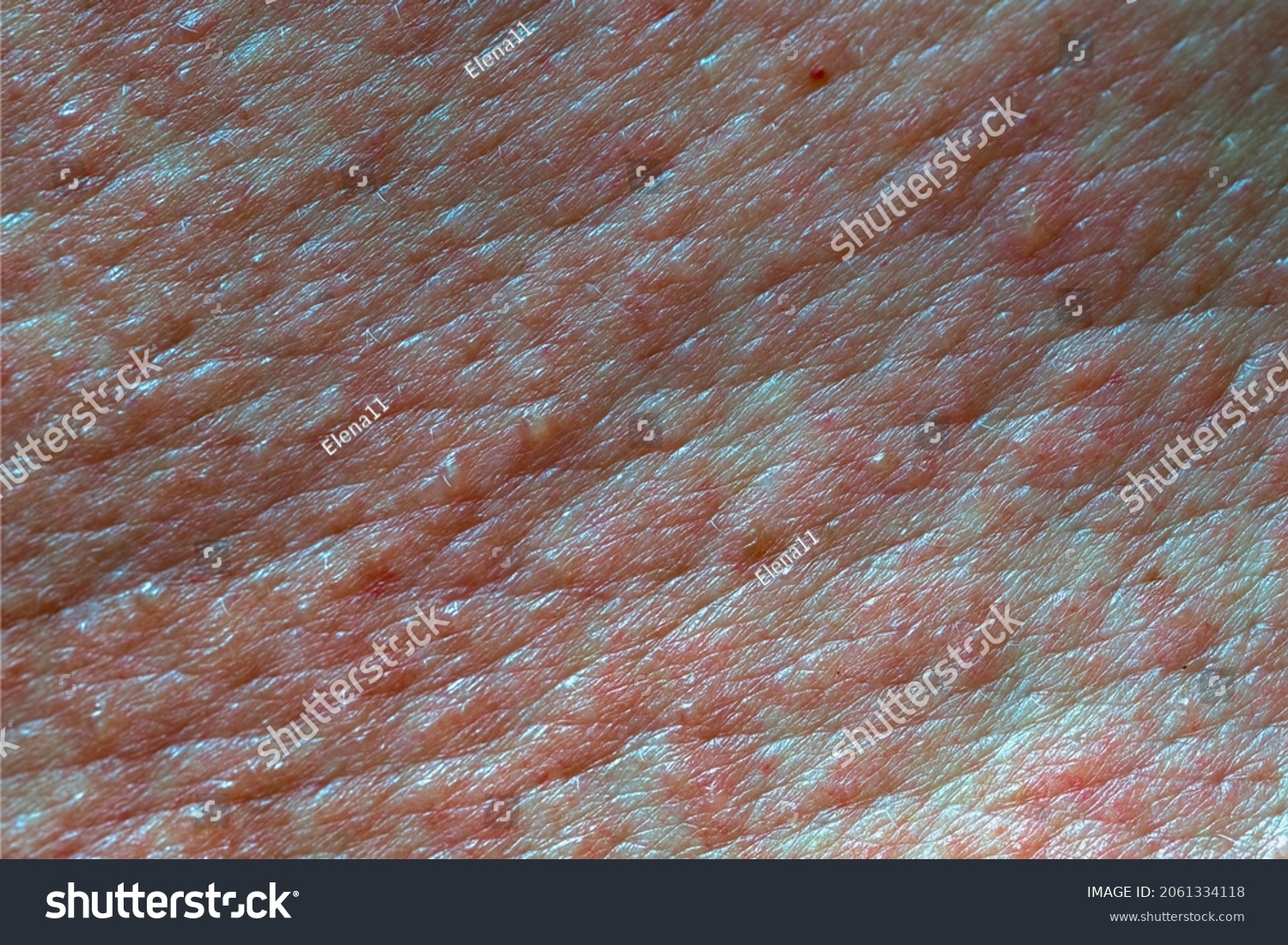 Skin Texture Painful Red Blisters Skin Stock Photo 2061334118 ...