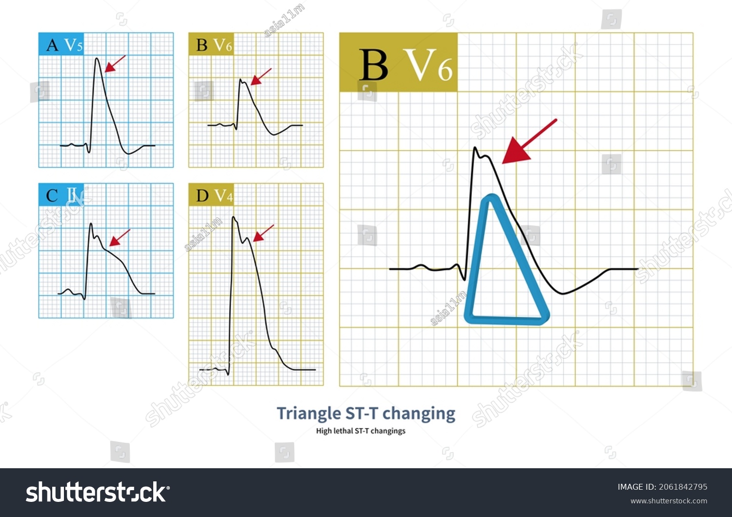 Acute Myocardial Infarction Stt Changes Found Stock Illustration ...