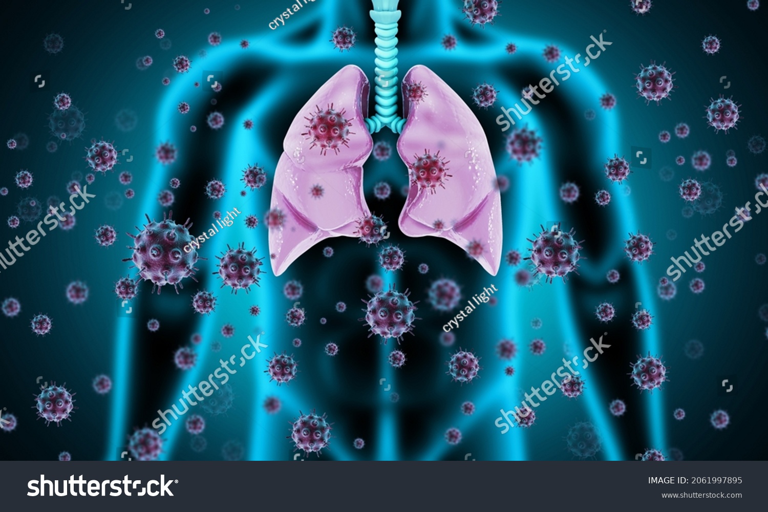 Virus Bacteria Infected Human Lungs Lung Stock Illustration 2061997895 