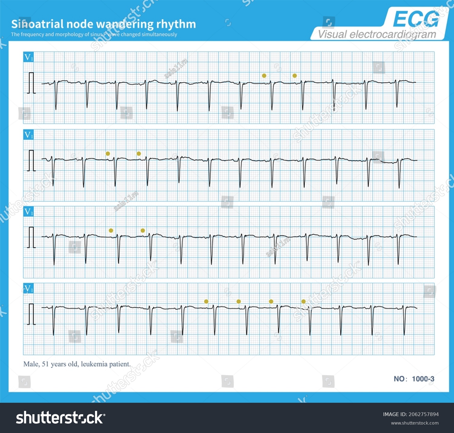 Frequency Change Sinus P Wave Not Stock Illustration 2062757894 ...