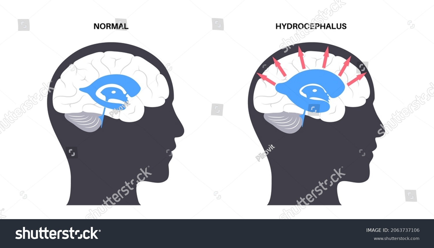 Hydrocephalus Shunt Concept Pressure On Brain Stock Vector (Royalty ...