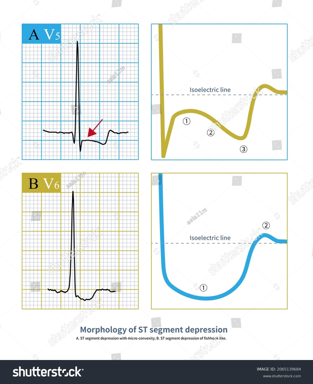 Morphology St Segment Depression Carefully Analyzed Stock Illustration ...