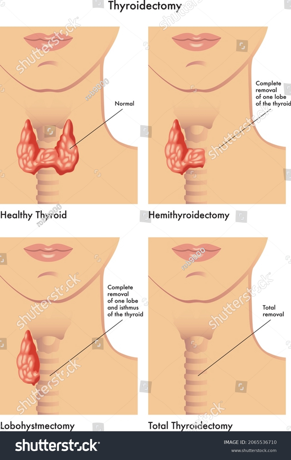 Thyroidectomy Bilder Durchsuchen Archivfotos Vektorgrafiken Und My