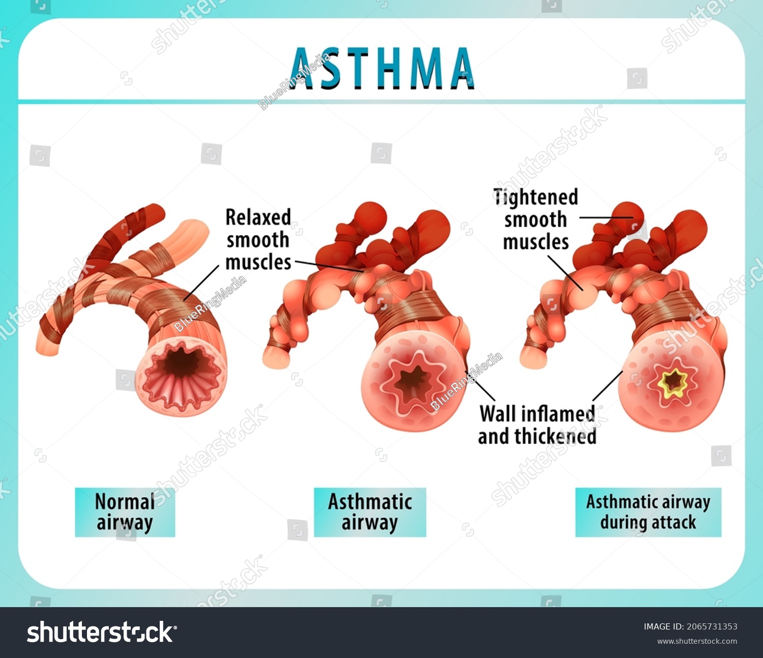 Bronchial Asthma Diagram Normal Airway Asthmatic Stock Vector (Royalty ...