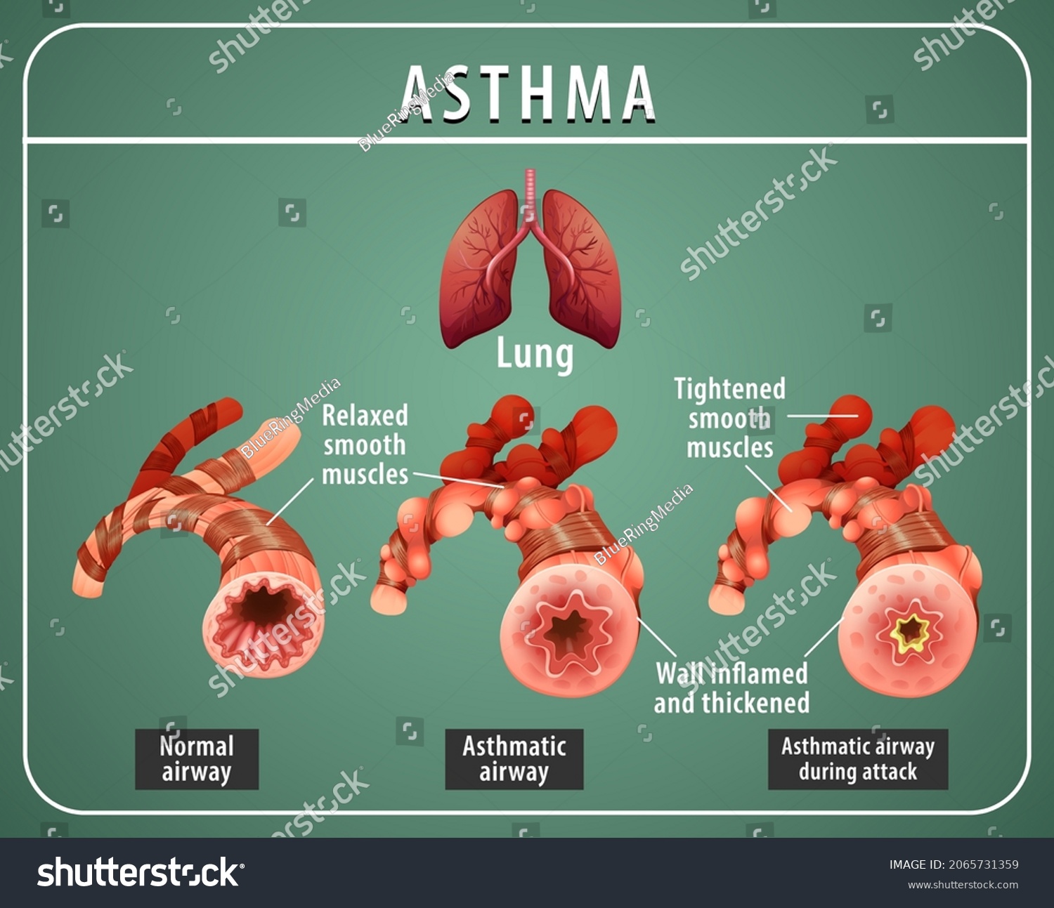 Asthma Diagram Normal Airway Asthmatic Airway Stock Vector (Royalty ...