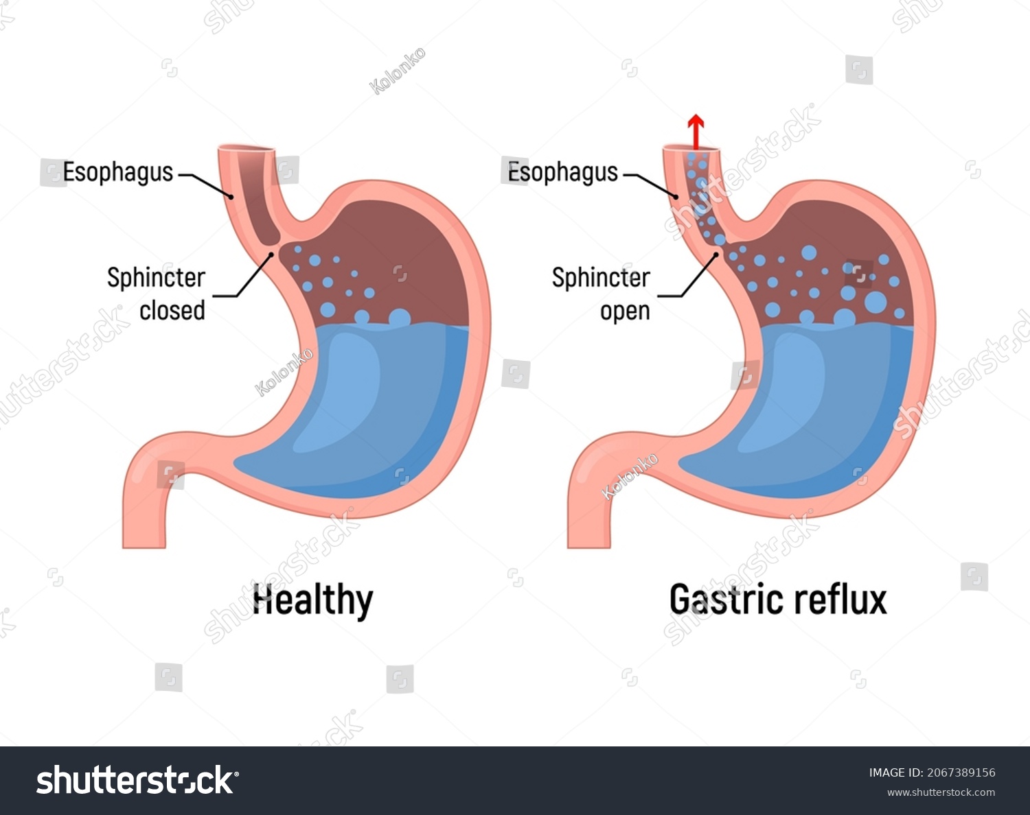 Esophageal Gastric Reflux Acid Indigestion Gastrointestinal Stock ...