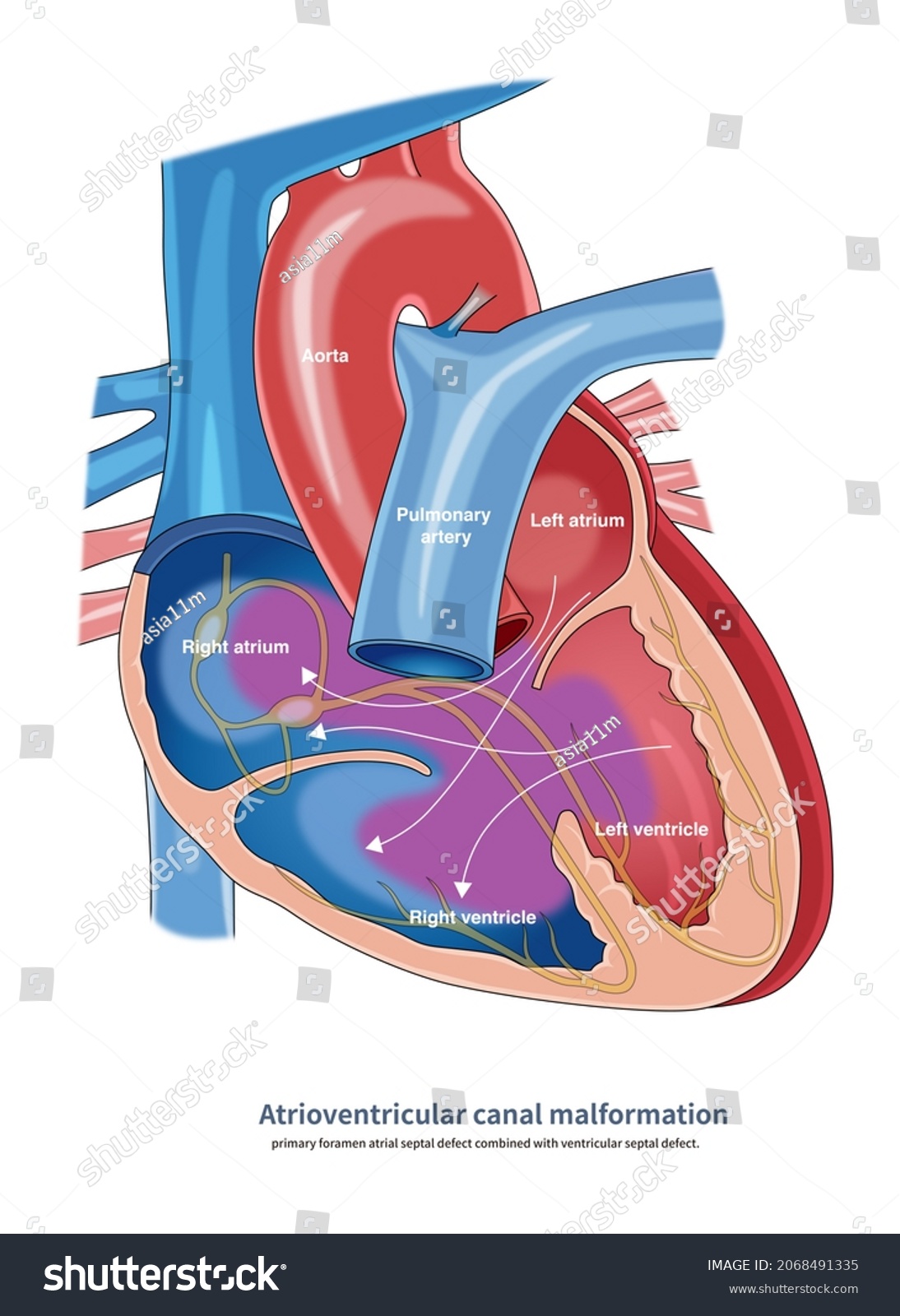 Atrioventricular Septal Defect Known Atrioventricular Canal Stock ...