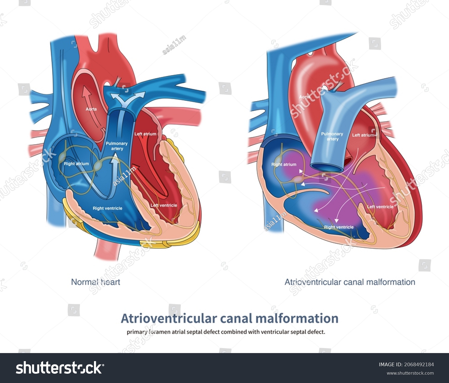 Atrioventricular Septal Defect Known Atrioventricular Canal 库存插图 2068492184 Shutterstock