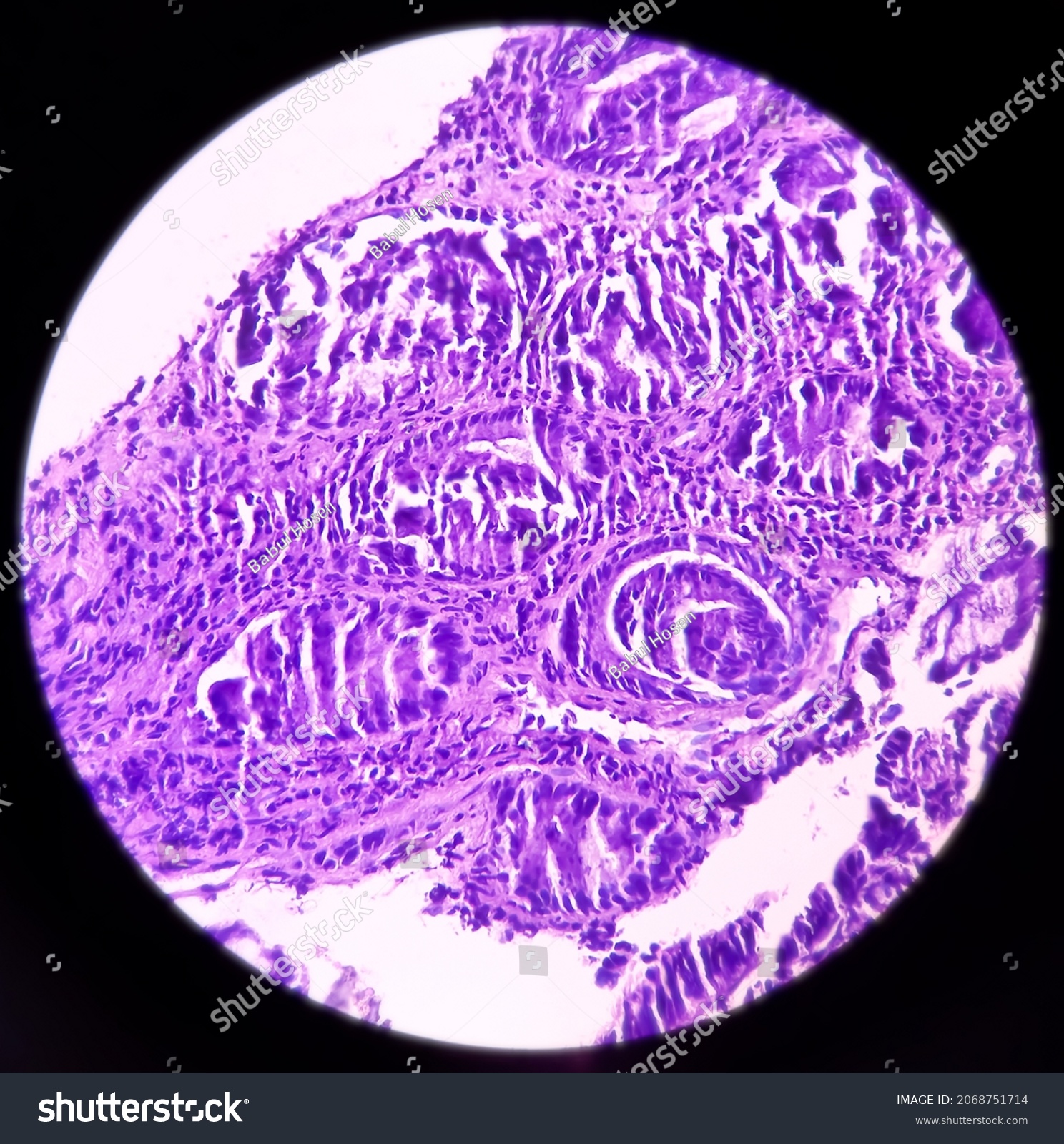 Colon Cancer Photomicrograph Microscopic Image Colorectum Stock Photo ...