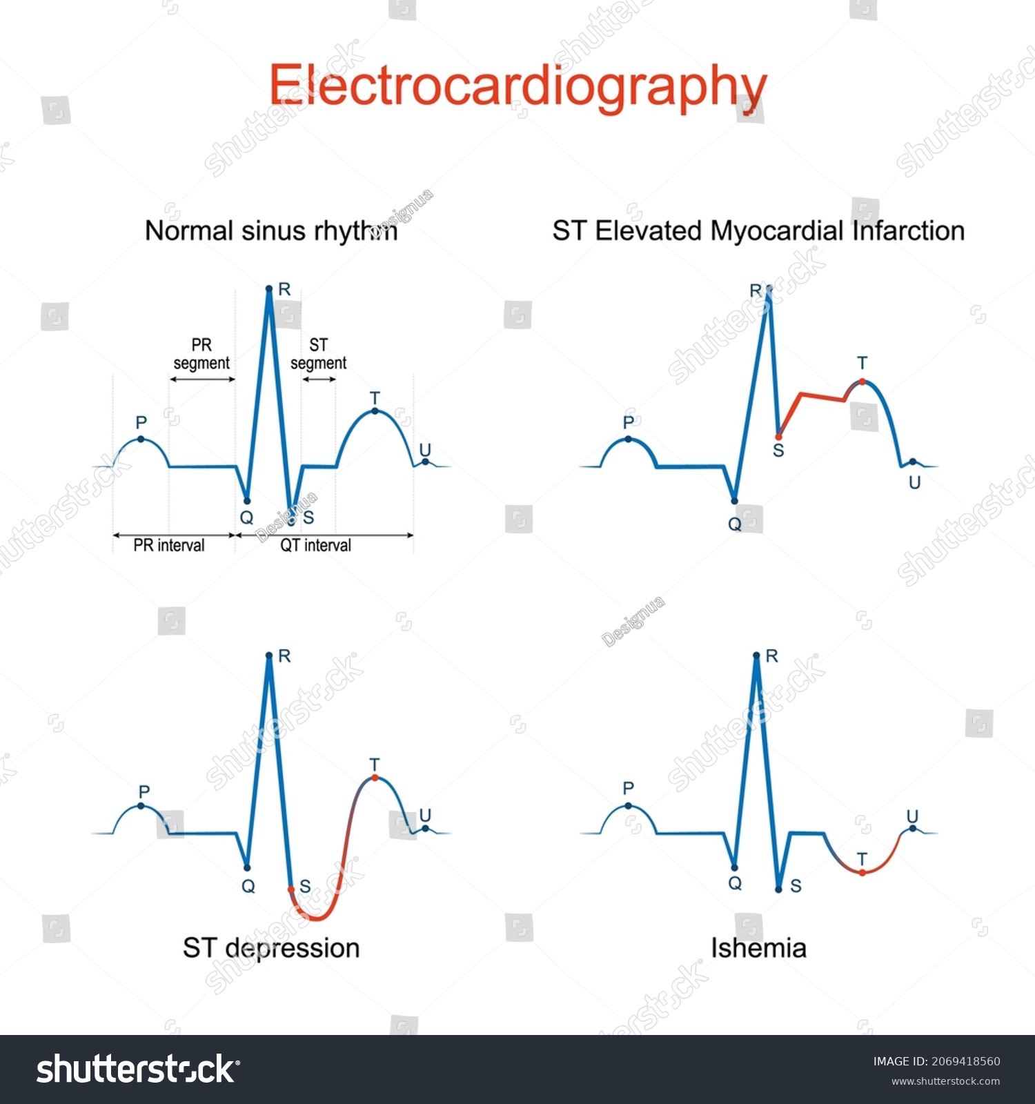 Electrocardiography Ecg Ekg Heart Normal Sinus Stock Vector (royalty 