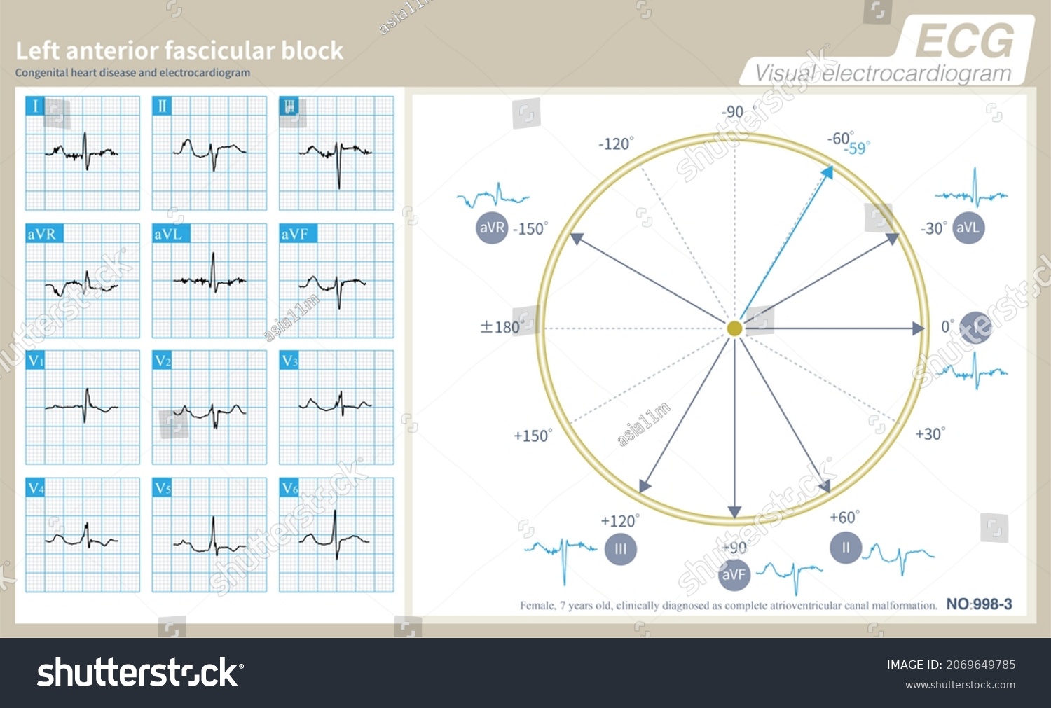 During Left Anterior Fascicular Block Left Stock Illustration 2069649785 Shutterstock