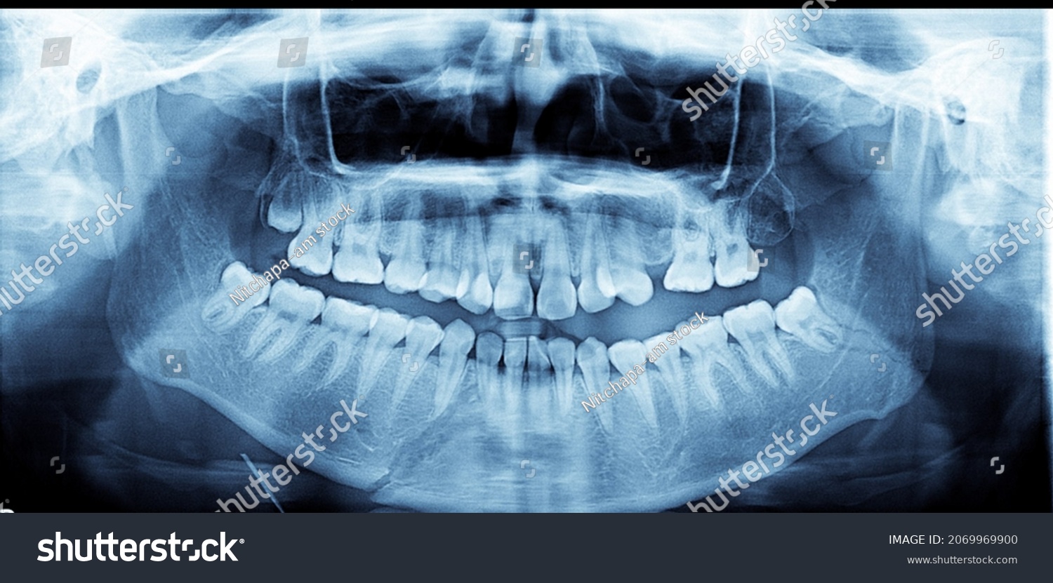 Xray Panoramic View Showing Fracture Mandiblecaused Stock Illustration 