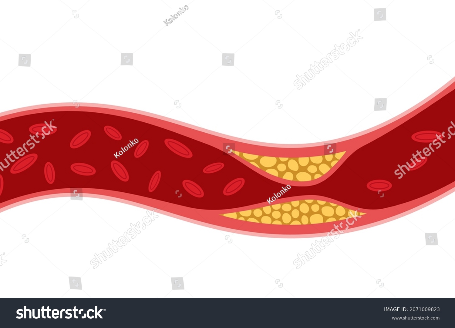 Cholesterol Artery Thrombosis Micro Vascular Disease Stock Vector ...