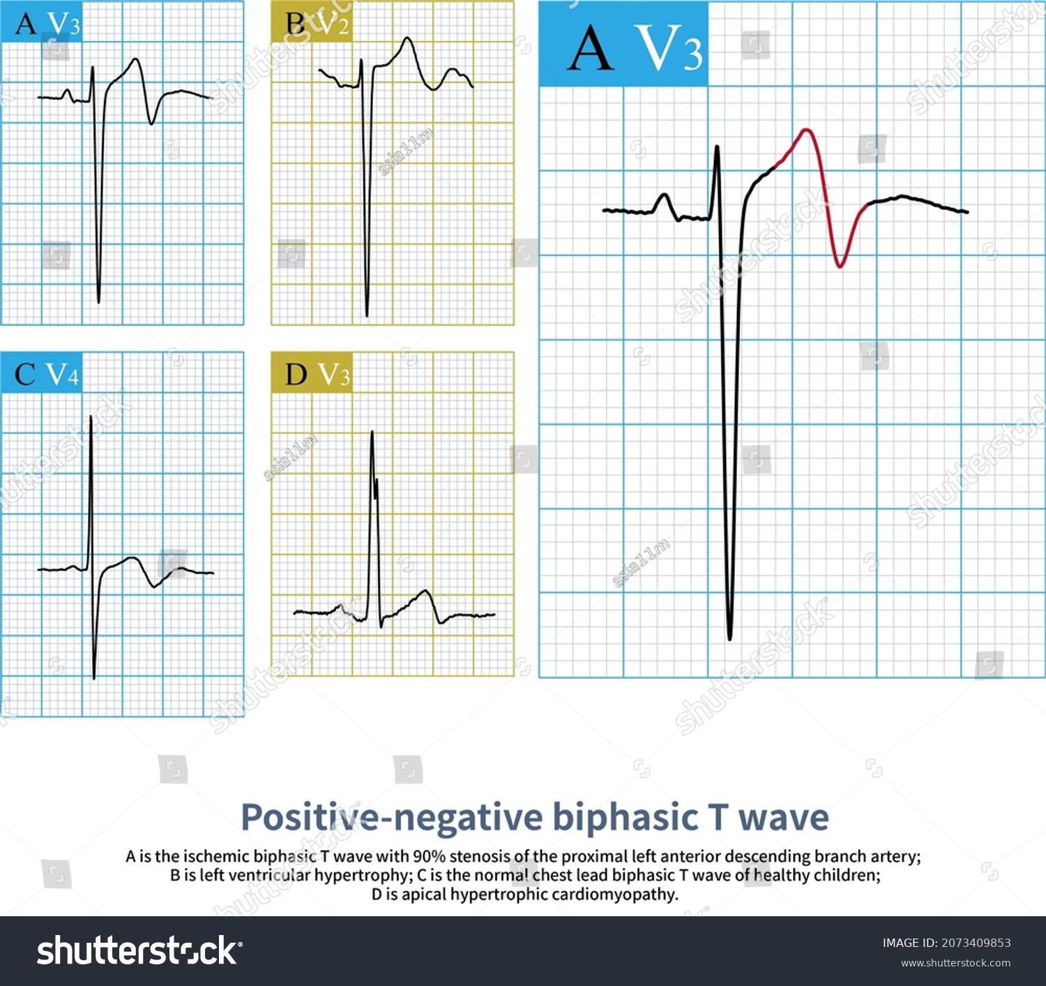 Positivenegative Biphasic T Wavepositive Negative Biphasic Stock ...