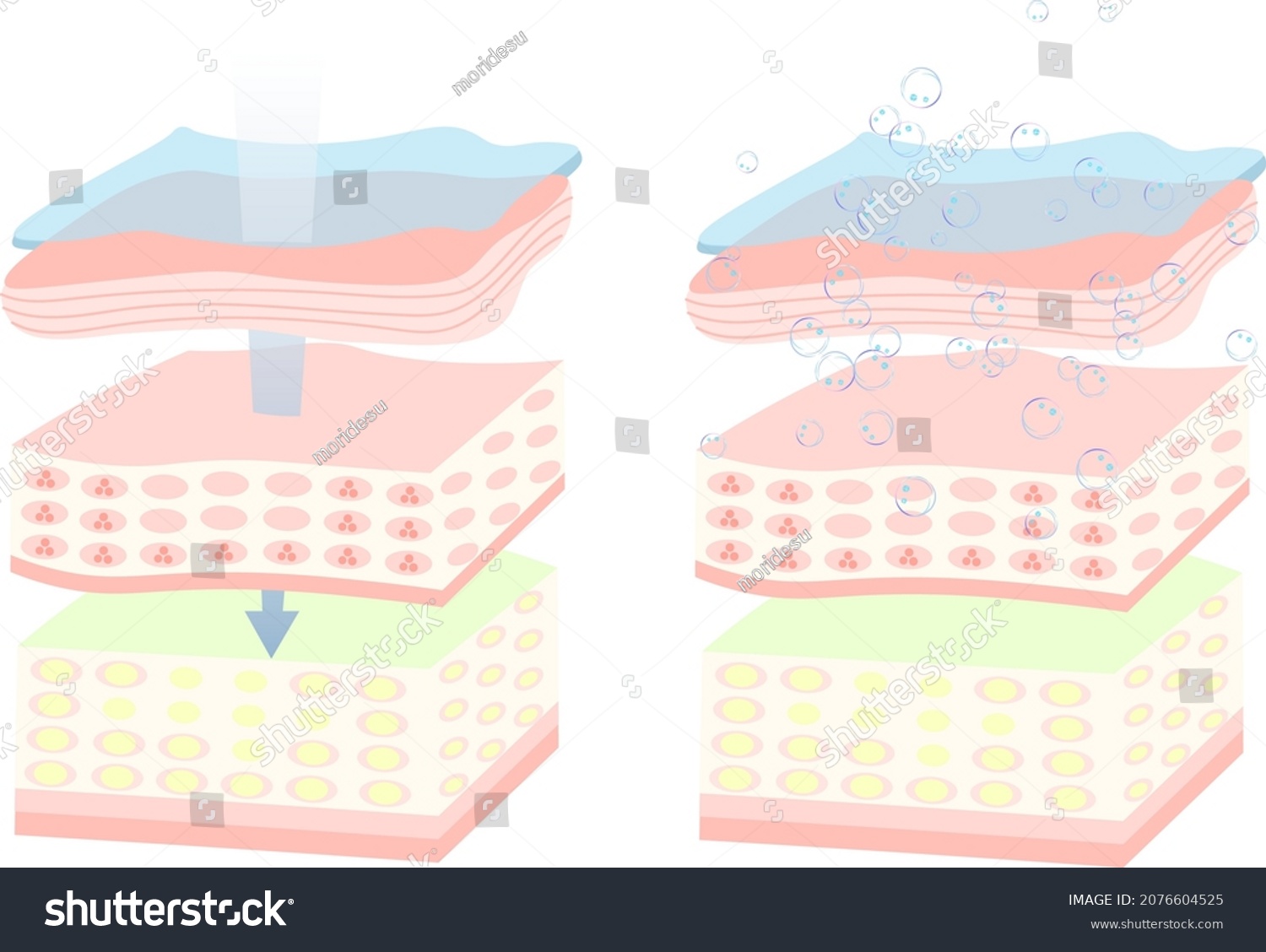 Moisturized Skin Dry Skin Cross Section Stock Vector (Royalty Free ...