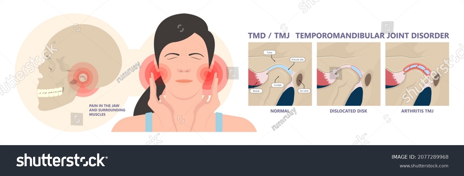 Temporomandibular Joint Disorders Tmd Tmj Treat Stock Vector (Royalty ...