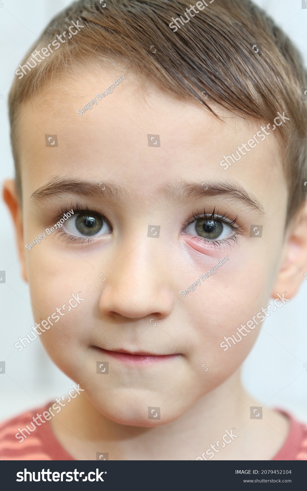 Stye Hordeolum Bacterial Infection Oil Gland Stock Photo 2079452104 ...