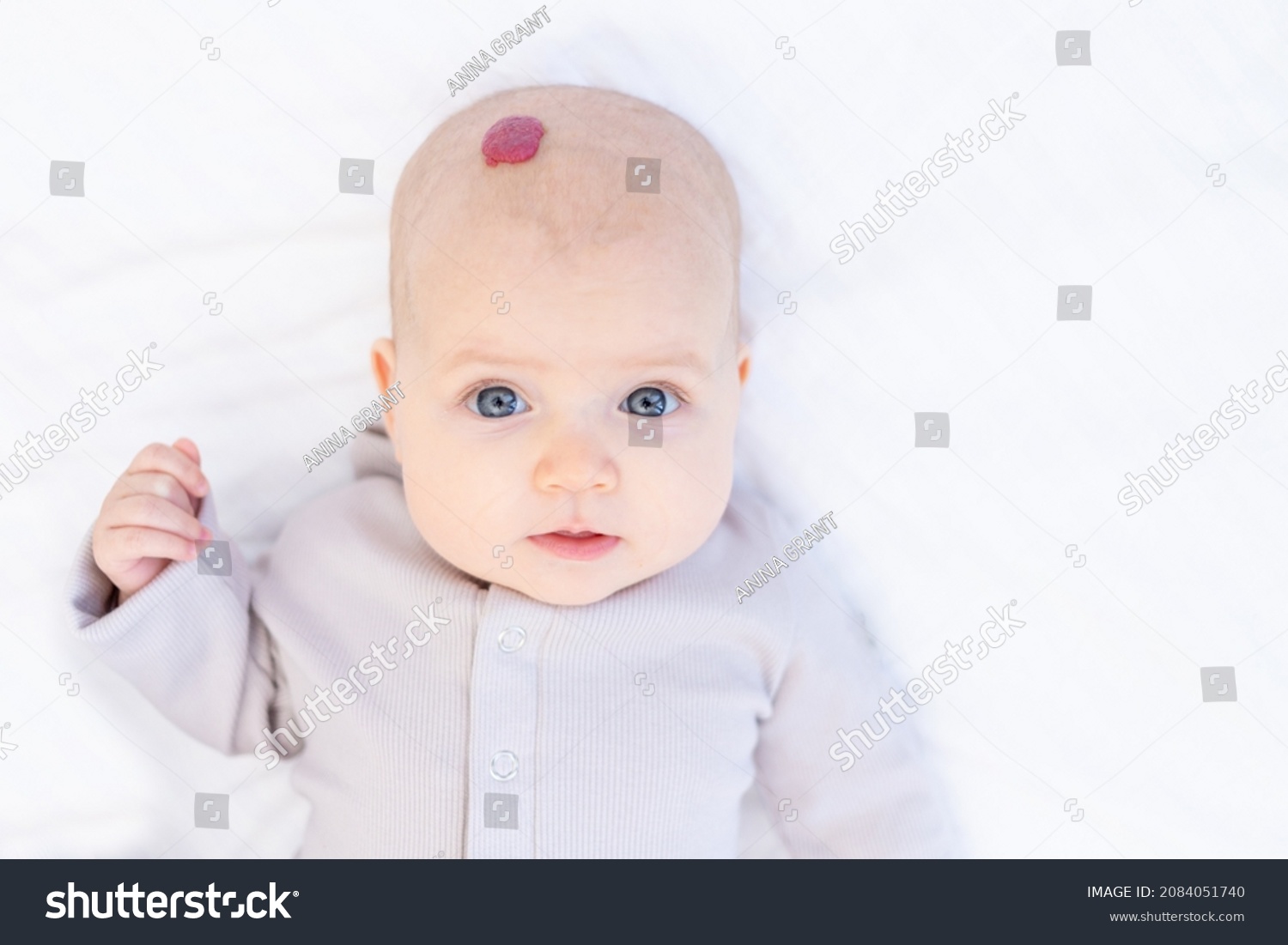 Hemangioma 552 Images Photos Et Images Vectorielles De Stock Shutterstock