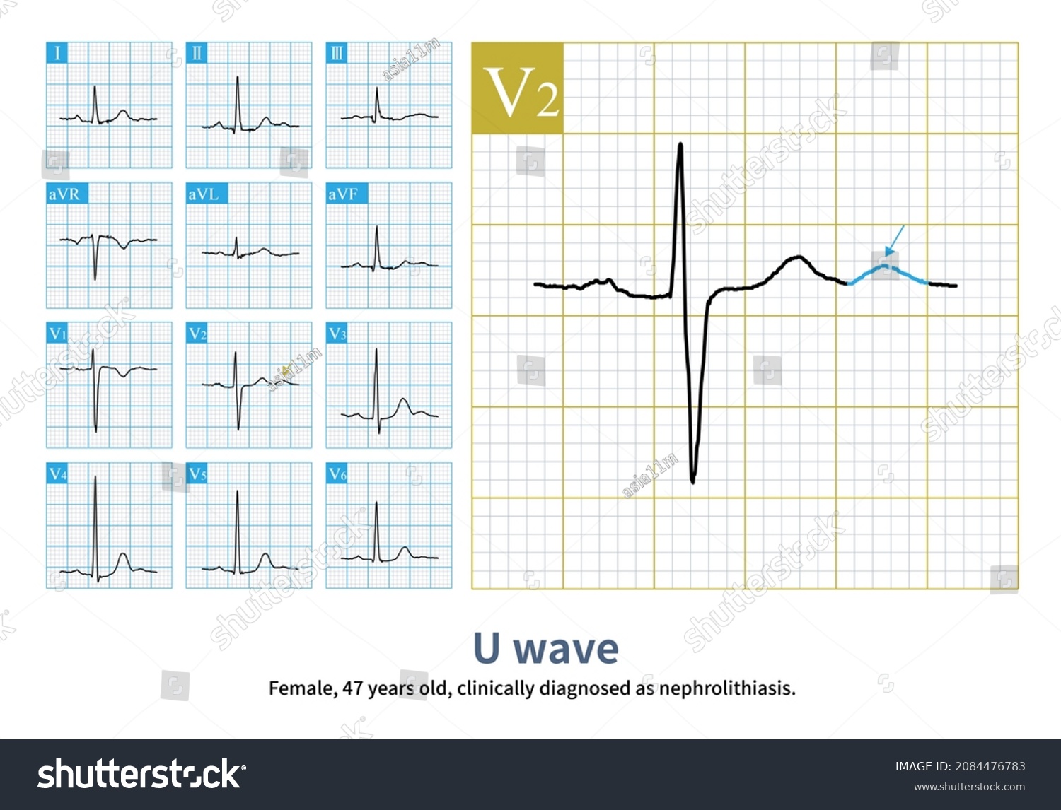 115 Ekg Wide Images, Stock Photos & Vectors | Shutterstock