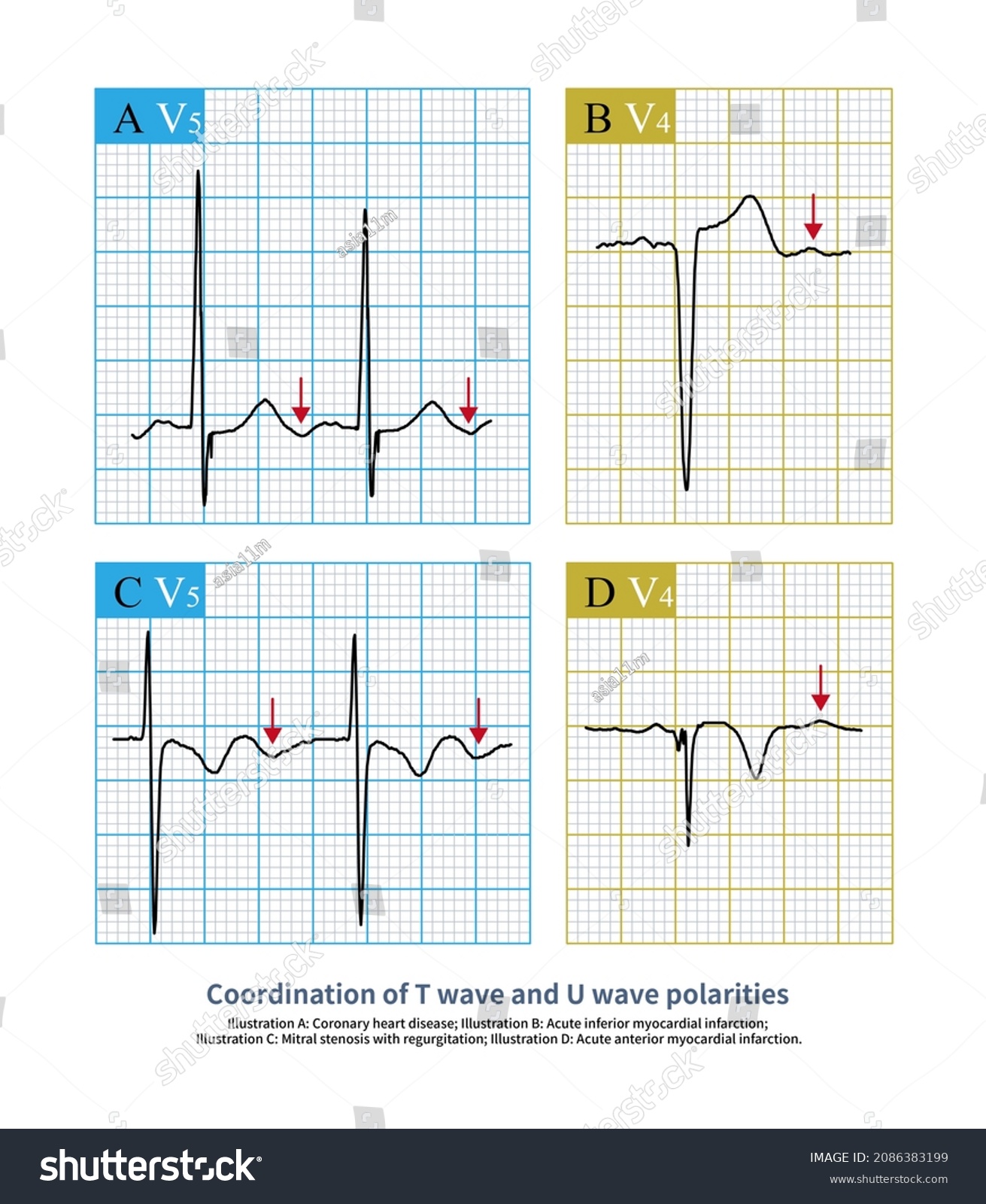 On Ecg When Polarity T Wave Stock Illustration 2086383199 | Shutterstock